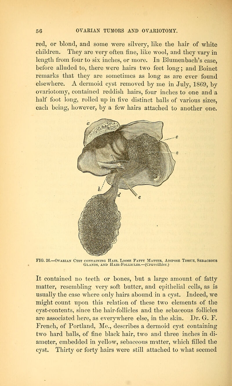 red, or blond, and some were silvery, like the hair of white children. They are very often fine, like wool, and they vary in length from four to six inches, or more. In Blumenbach's case, before alluded to, there were hairs two feet long; and Boinet remarks that they are sometimes as long as are ever found elsewhere. A dermoid cyst removed by me in July, 1869, by ovariotomy, contained reddish hairs, four inches to one and a half foot long, rolled up in five distinct balls of various sizes, each being, however, by a few hairs attached to another one. FIG. 26.—Ovarian Cyst containing Hate. Loose Fatty Matter, Adipose Tissue, Sebaceous Glands, and Hair-Follicles.—(Craveilhier.) It contained no teeth or bones, but a large amount of fatty matter, resembling very soft butter, and epithelial cells, as is usually the case where only hairs abound in a cyst. Indeed, we might count upon this relation of these two elements of the cyst-contents, since the hair-follicles and the sebaceous follicles are associated here, as everywhere else, in the skin. Dr. Gr. F. French, of Portland, Me., describes a dermoid cyst containing two hard balls, of fine black hair, two and three inches in di- ameter, embedded in yellow, sebaceous matter, which filled the cyst. Thirty or forty hairs were still attached to what seemed