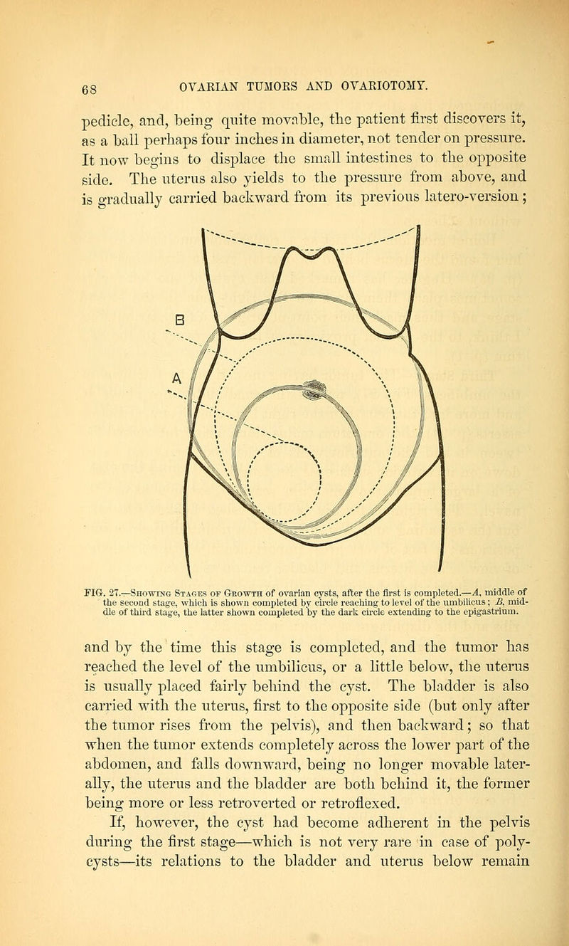 pedicle, and, being quite movable, the patient first discovers it, as a ball perhaps four inches in diameter, not tender on pressure. It now begins to displace the small intestines to the opposite side. The uterus also yields to the pressure from above, and is gradually carried backward from its previous latero-version ; FIG. 27.—Showing Stages op Growth of ovarian cysts, after the first is completed.—A, middle of ' the second stage, which is shown completed by circle reaching to level of the umbilicus; JS, mid- dle of third stage, the latter shown completed'by the dark circle extending to the epigastrium. and by the time this stage is completed, and the tumor has reached the level of the umbilicus, or a little below, the uterus is usually placed fairly behind the cyst. The bladder is also carried with the uterus, first to the opposite side (but only after the tumor rises from the pelvis), and then backward; so that when the tumor extends completely across the lower part of the abdomen, and falls downward, being no longer movable later- ally, the uterus and the bladder are both behind it, the former being more or less retroverted or retroflexed. If, however, the cyst had become adherent in the pelvis during the first stage—which is not very rare in case of poly- cysts—its relations to the bladder and uterus below remain