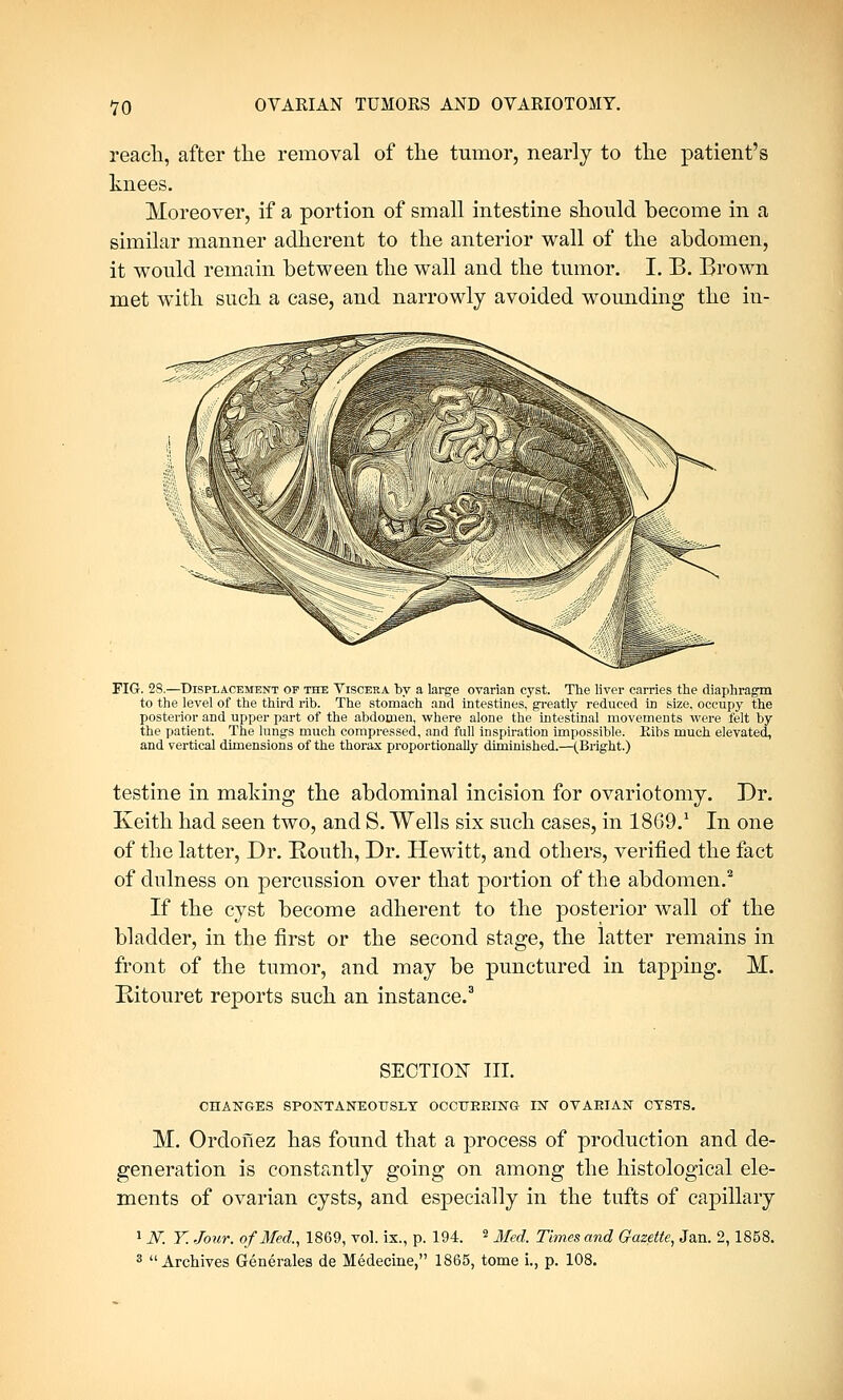 reach, after the removal of the tumor, nearly to the patient's knees. Moreover, if a portion of small intestine should become in a similar manner adherent to the anterior wall of the abdomen, it would remain between the wall and the tumor. I. B. Brown met with such a case, and narrowly avoided wounding the in- FIG. 28.—Displacement op the Viscera by a large ovarian cyst. The liver carries the diaphragm to the level of the third rib. The stomach and intestines, greatly reduced in size, occupy the posterior and upper part of the abdomen, where alone the intestinal movements were felt by the patient. The lungs much compressed, and full inspiration impossible. Eibs much elevated, and vertical dimensions of the thorax proportionally diminished,—(Bright.) testine in making the abdominal incision for ovariotomy. Dr. Keith had seen two, and S. Wells six such cases, in 1869.1 In one of the latter, Dr. Routh, Dr. Hewitt, and others, verified the fact of dulness on percussion over that portion of the abdomen.2 If the cyst become adherent to the posterior wall of the bladder, in the first or the second stage, the latter remains in front of the tumor, and may be punctured in tapping. M. Bitouret reports such an instance.3 SECTION III. CHANGES SPONTANEOUSLY OCCURRING IN OVARIAN CYSTS. M. Ordonez has found that a process of production and de- generation is constantly going on among the histological ele- ments of ovarian cysts, and especially in the tufts of capillary 1 V. Y. Jour, of Med., 1869, vol. ix., p. 194. 2 Med. Times and Gazette, Jan. 2,1858.