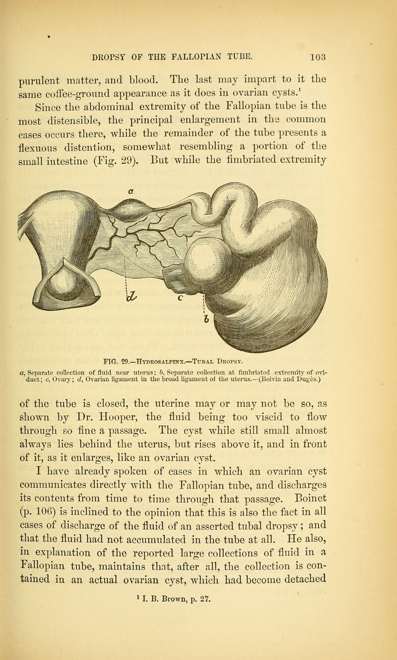 purulent matter, and blood. The last may impart to it the same coffee-ground appearance as it does in ovarian cysts.1 Since the abdominal extremity of the Fallopian tube is the most distensible, the principal enlargement in the common cases occurs there, while the remainder of the tube presents a flexuous distention, somewhat resembling a portion of the small intestine (Fig. 29). But while the fimbriated extremity FIG. 29.—TIydrosalptnx.—Tubal Dkopst. a, Separate collection of fluid near uterus; &, Separate collection at fimbriated extremity of ovi- duct; c, Ovary; d, Ovarian ligament in the broad ligament of the uterus.—(Boivin and Duges.) of the tube is closed, the uterine may or may not be so, as shown by Dr. Hooper, the fluid being too viscid to flow through so fine a passage. The cyst while still small almost always lies behind the uterus, but rises above it, and in front of it, as it enlarges, like an ovarian cyst. I have already spoken of cases in which an ovarian cyst communicates directly with the Fallopian tube, and discharges its contents from time to time through that passage. Boinet (p. 106) is inclined to the opinion that this is also the fact in all cases of discharge of the fluid of an asserted tubal dropsy; and that the fluid had not accumulated in the tube at all. He also, in explanation of the reported large collections of fluid in a Fallopian tube, maintains that, after all, the collection is con- tained in an actual ovarian cyst, which had become detached 1 I. B. Brown, p. 27.