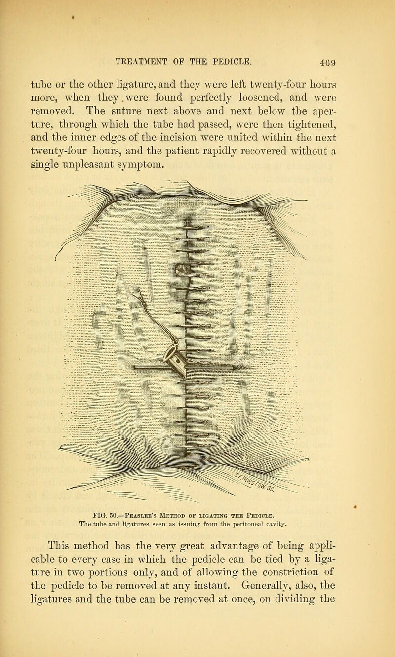 tube or the other ligature, and they were left twenty-four hours more, when they .were found perfectly loosened, and were removed. The suture next above and next below the aper- ture, through which the tube had passed, were then tightened, and the inner edges of the incision were united within the next twenty-four hours, and the patient rapidly recovered without a single unpleasant symptom. FIG. 50.—Peaslee1s Method of ligatmg the Pedicle. The tube and ligatures seen as issuing from the peritoneal cavity. This method has the very great advantage of being appli- cable to every case in which the pedicle can be tied by a liga- ture in two portions only, and of allowing the constriction of the pedicle to be removed at any instant. Generally, also, the ligatures and the tube can be removed at once, on dividing the