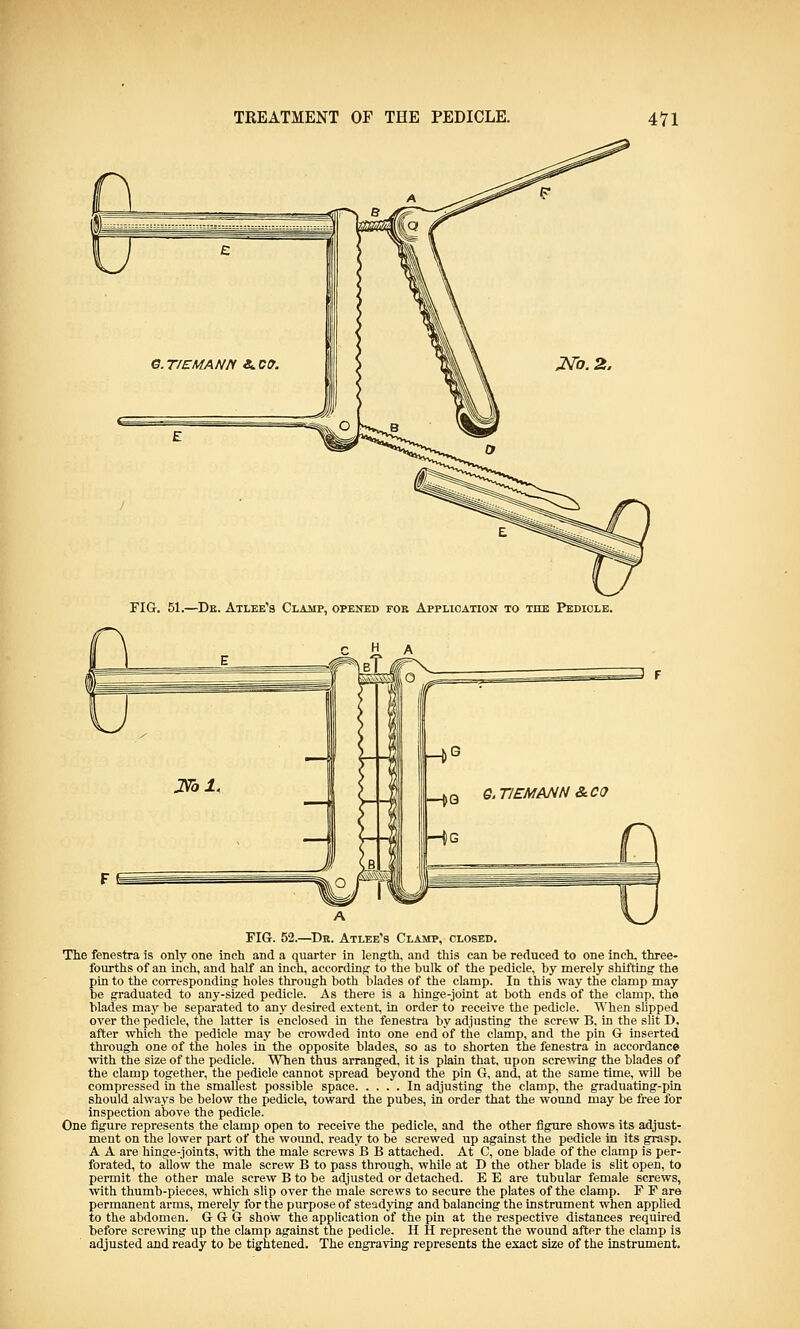 FIG. 51.—Dk. Atlee's Clamp, opened for Application to the Pedicle. FIG. 52.—Dr. Atlee's Clamp, closed. The fenestra is only one inch and a quarter in length, and this can be reduced to one inch, three- fourths of an inch, and half an inch, according: to the bulk of the pedicle, by merely shifting the pin to the corresponding holes through both blades of the clamp. In this way the clamp may be graduated to any-sized pedicle. As there is a hinge-joint at both ends of the clamp, the blades may be separated to any desired extent, in order to receive the pedicle. When slipped over the pedicle, the latter is enclosed in the fenestra by adjusting the screw B, in the slit D, after which the pedicle may be crowded into one end of the clamp, and the pin G inserted through one of the holes in the opposite blades, so as to shorten the fenestra in accordance with the size of the pedicle. When thus arranged, it is plain that, upon screwing the blades of the clamp together, the pedicle cannot spread beyond the pin G, and, at the same time, will be compressed in the smallest possible space In adjusting the clamp, the graduating-pin should always be below the pedicle, toward the pubes, in order that the wound may be free for inspection above the pedicle. One figure represents the clamp open to receive the pedicle, and the other figure shows its adjust- ment on the lower part of the wound, ready to be screwed up against the pedicle in its grasp. A A are hinge-joints, with the male screws B B attached. At C, one blade of the clamp is per- forated, to allow the male screw B to pass through, while at B the other blade is slit open, to permit the other male screw B to be adjusted or detached. E E are tubular female screws, with thumb-pieces, which slip over the male screws to secure the plates of the clamp. F F are permanent arms, merely for the purpose of steadying and balancing the instrument when applied to the abdomen. G G G show the application of the pin at the respective distances required before screwing up the clamp against the pedicle, H H represent the wound after the clamp is adjusted and ready to be tightened. The engraving represents the exact size of the instrument.