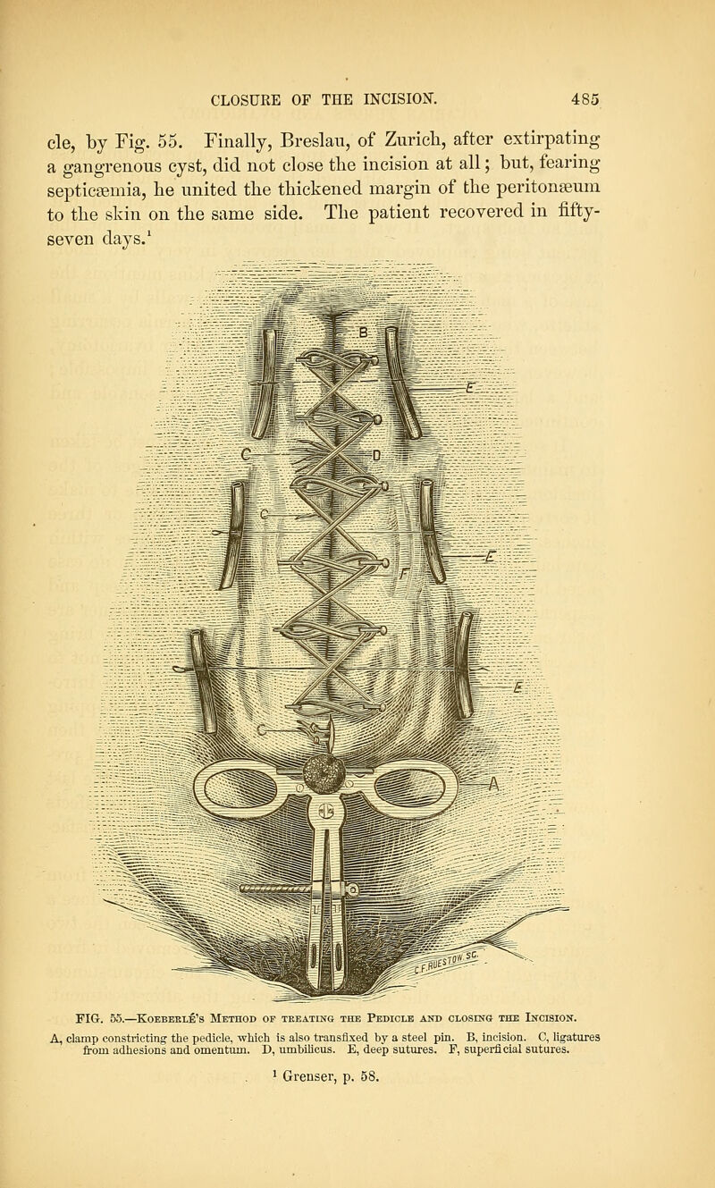 cle, by Fig. 55. Finally, Breslau, of Zurich, after extirpating a gangrenous cyst, did not close the incision at all; but, fearing septicaemia, he united the thickened margin of the peritonaeum to the skin on the same side. The patient recovered in fifty- seven days.1 FIG. 55.—Koebekle's Method of treating the Pedicle and closing the Incision. A, clamp constricting the pedicle, which is also transfixed by a steel pin. B, incision. C, ligatures from adhesions and omentum. D, umbilicus. E, deep sutures. F, superficial sutures.
