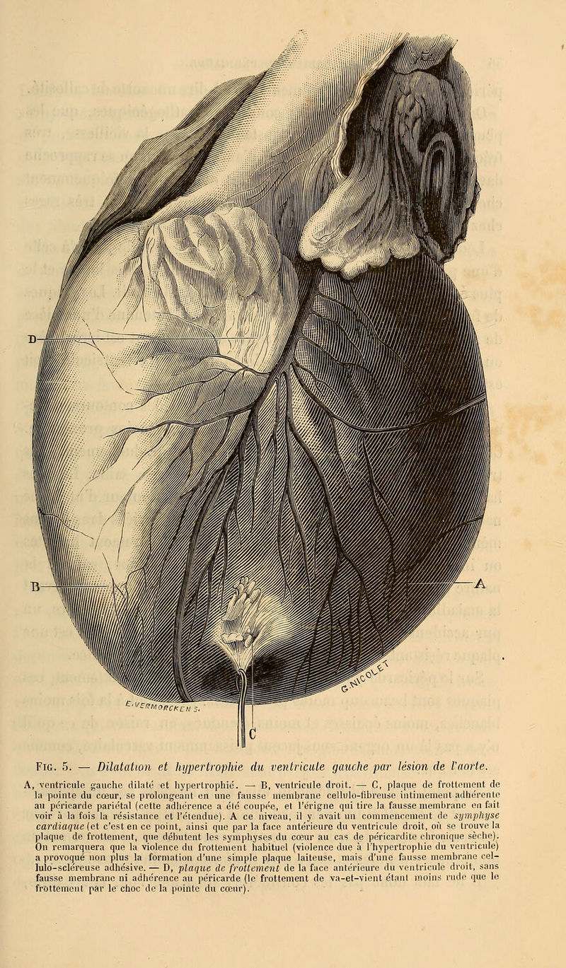 Fig. 5. — Dilatation et hypertrophie du ventricule gauche par lésion de l'aorte. A, ventricule gauche dilaté et hypertrophié. — B, ventricule droit. — C, plaque de frottement de la pointe du cœur, se prolongeant en une fausse membrane cellulo-fibreuse intimement adhérente au péricarde pariétal (cette adhérence a été coupée, et l'érigne qui tire la fausse membrane en fait voir à la fois la résistance et l'étendue). A ce niveau, il y avait un commencement de symphyse cardiaque (et c'est en ce point, ainsi que par la face antérieure du ventricule droit, où se trouve la plaque de frottement, que débutent les symphyses du cœur au cas de péricardite chronique sèche). On remarquera que la violence du frottement habituel (violence due à l'hypertrophie du ventricule) a provoqué non plus la formation d'une simple plaque laiteuse, mais d'une fausse membrane cel- lulo-scléreuse adhésive. — D, plaque de frottement de la face antérieure du ventricule droit, sans fausse membrane ni adhérence au péricarde (le frottement de va-et-vient étant moins rude que le frottement par le choc de la pointe du cœur).