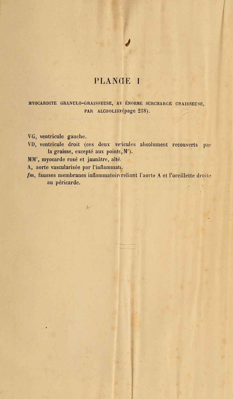 MYOCARDITE GRANULO-GRAISSEUSE, AV ÉNORME SURCHARGE GRAISSEUSE, par ALCOOLisy(page 218). VG, ventricule gauche. VD, ventricule droit (ces deux véhicules absolument recouverts par la graisse, excepté aux points, M'). MM', myocarde rosé et jaunâtre, alté. A, aorte vascularisée par l'inflammati. fm, fausses membranes inflammatoin reliant l'aorte A et l'oreillette drpile au péricarde. u-