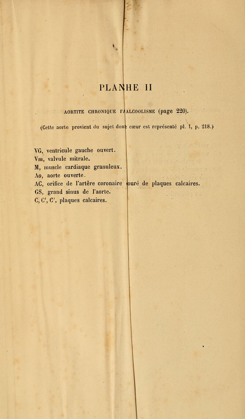A0RT1TE CHRONIQUE fJalCOOLISME (page 220). (Cette aorte provient du sujet dont cœur est représenté pi. I, p. 218.) VG, ventricule gauche ouvert. Vm, valvule mitrale. M, muscle cardiaque granuleux. Ao, aorte ouverte. AC, orifice de l'artère coronaire GS, grand sinus de l'aorte. C, C, C, plaques calcaires. (ouré de plaques calcaires.