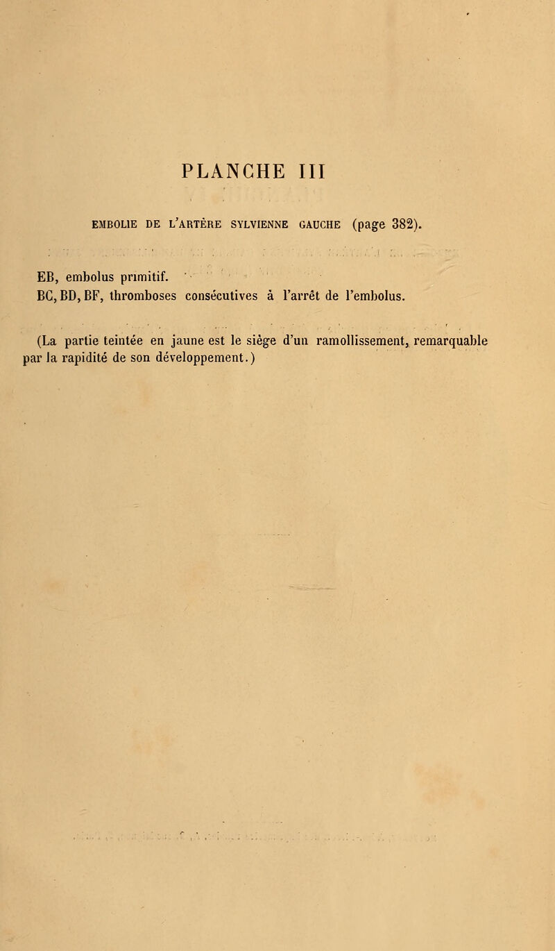EMBOLIE de i/artère sylvienne gauche (page 382). EB, embolus primitif. BG, BD, BF, thromboses consécutives à l'arrêt de l'embolus. (La partie teintée en jaune est le siège d'un ramollissement, remarquable par la rapidité de son développement.)