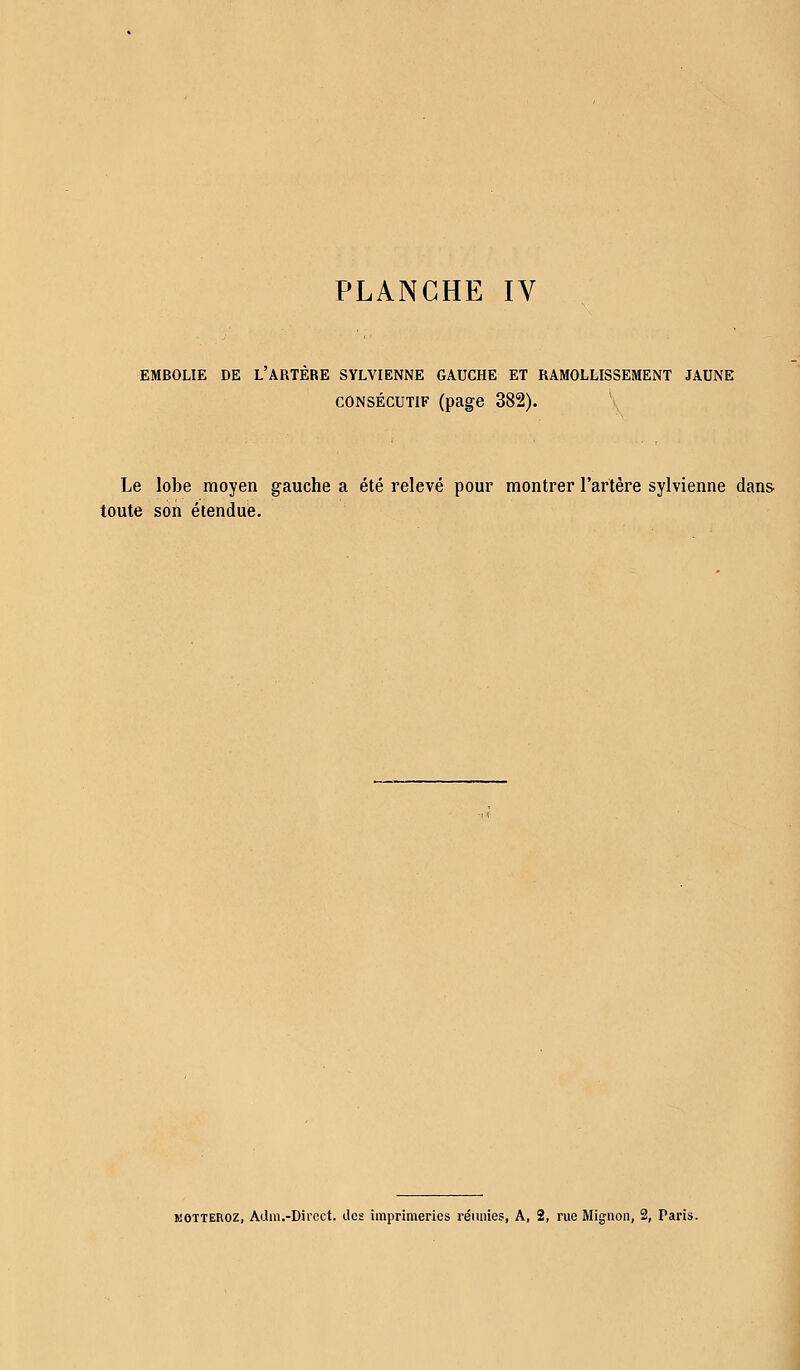 EMBOLIE DE L ARTERE SYLVIENNE GAUCHE ET RAMOLLISSEMENT JAUNE consécutif (page 382). Le lobe moyen gauche a été relevé pour montrer l'artère sylvienne dans- toute son étendue. motteroz, Adra.-Direct. des imprimeries réunies, A, 2, rue Mignon, 2, Paris.