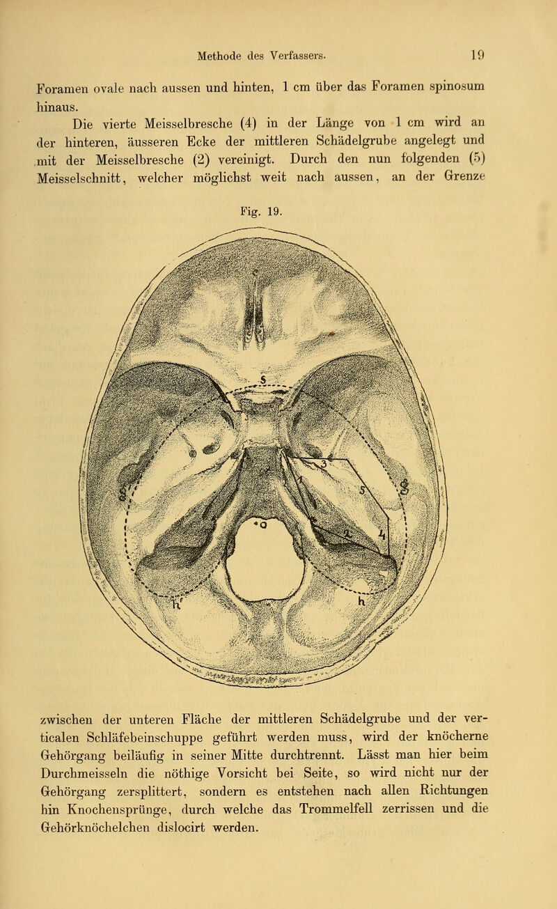 Foramen ovale nach aussen und hinten, 1 cm über das Foramen spinosum hinaus. Die vierte Meisselbresche (4) in der Länge von 1 cm wird an der hinteren, äusseren Ecke der mittleren Schädelgrube angelegt und mit der Meisselbresche (2) vereinigt. Durch den nun folgenden (5) Meisselschnitt, welcher möglichst weit nach aussen, an der Grenze Fig. 19. zwischen der unteren Fläche der mittleren Schädelgrube und der ver- ticalen Schläfebeinschuppe geführt werden muss, wird der knöcherne Gehörgang beiläufig in seiner Mitte durchtrennt. Lässt man hier beim Durchmeisseln die nöthige Vorsicht bei Seite, so wird nicht nur der Gehörgang zersplittert, sondern es entstehen nach allen Richtungen hin Knochensprünge, durch welche das Trommelfell zerrissen und die Gehörknöchelchen dislocirt werden.