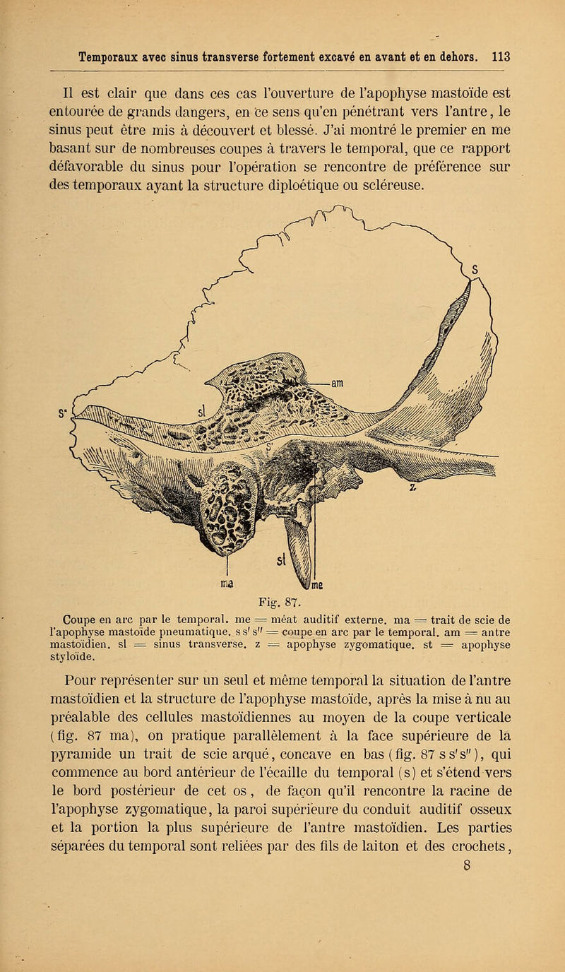 Il est clair que dans ces cas l'ouverture de l'apophyse mastoïde est entourée de grands dangers, en Ce sens qu'en pénétrant vers l'antre, le sinus peut être mis à découvert et blessé. J'ai montré le premier en me basant sur de nombreuses coupes à travers le temporal, que ce rapport défavorable du sinus pour l'opération se rencontre de préférence sur des temporaux ayant la structure diploétique ou scléreuse. Fig. 87. Coupe en arc par le temporal, me = méat auditif externe, ma = trait de scie de l'apophyse mastoïde pneumatique, s s's = coupe en arc par le temporal, am = antre mastoïdien, si = sinus transverse, z = apophyse zygomatique. st = apophyse styloïde. Pour représenter sur un seul et même temporal la situation de l'antre mastoïdien et la structure de l'apophyse mastoïde, après la mise à nu au préalable des cellules mastoïdiennes au moyen de la coupe verticale (fig. 87 ma), on pratique parallèlement à la face supérieure de la pyramide un trait de scie arqué, concave en bas ( fig. 87 s s's ), qui commence au bord antérieur de l'écaillé du temporal (s) et s'étend vers le bord postérieur de cet os, de façon qu'il rencontre la racine de l'apophyse zygomatique, la paroi supérieure du conduit auditif osseux et la portion la plus supérieure de l'antre mastoïdien. Les parties séparées du temporal sont reliées par des fils de laiton et des crochets,