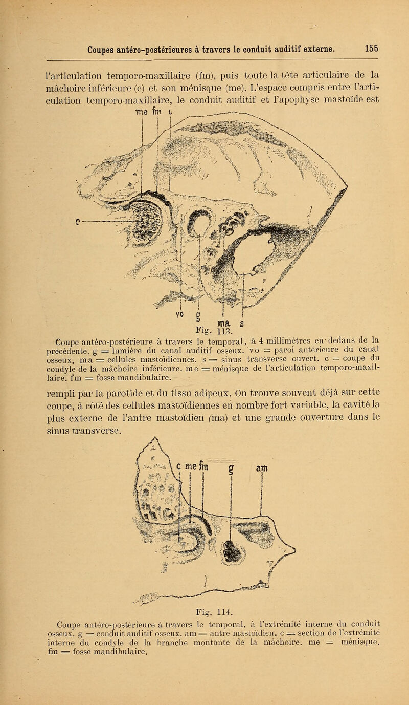 l'articulation temporo-maxillaire (fm), puis toute la tête articulaire de la mâchoire inférieure (c) et son ménisque (me). L'espace compris entre l'arti* culation temporo-maxillaire, le conduit auditif et l'apophyse mastoïde est m 3 fin t ^-c-~_^^ -..'<• ï ' *. m* s Fig- 113. Coupe antéro-postérieure à travers le temporal, à 4 millimètres en-dedans de la précédente, g = lumière du canal auditif osseux, vo = paroi antérieure du canal osseux, ma = cellules mastoïdiennes. s'= sinus transverse ouvert, c = coupe du condyle de la mâchoire inférieure, me = ménisque de l'articulation temporo-maxil- laire. fm = fosse mandibulaire. rempli par la parotide et du tissu adipeux. On trouve souvent déjà sur cette coupe, à côté des cellules mastoïdiennes eii nombre fort variable, la cavité la plus externe de l'antre mastoïdien (ma) et une grande ouverture dans le sinus transverse. Fig. 114. Coupe antéro-postérieure à travers le temporal, à l'extrémité interne du conduit osseux, g = conduit auditif osseux. am= antre mastoïdien, c = section de l'extrémité interne du condyle de la branche montante de la mâchoire, me = ménisque, fm = fosse mandibulaire.