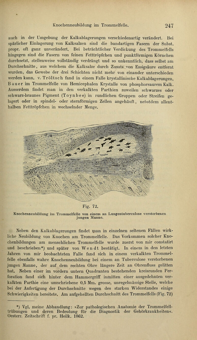 auch in der Umgebung der Kalkablagerungen verschiedenartig verändert. Bei spärlicher Einlagerung von Kalksalzen sind die bandartigen Fasern der Subst. propr. oft ganz unverändert. Bei beträchtlicher Verdickung des Trommelfells hingegen sind die Fasern von feinen Fetttröpfchen und punktförmigen Körnchen durchsetzt, stellenweise vollständig verdrängt und so unkenntlich, dass selbst am Durchschnitte, aus welchem die Kalksalze durch Zusatz von Essigsäure entfernt wurden, das Gewebe der drei Schichten nicht mehr von einander unterschieden werden kann. v. Tröltsch fand in einem Falle krystallinische Kalkablagerungen, Bauer im Trommelfelle von Hemicephalen Krystalle von phosphorsaurem Kalk. Ausserdem findet man in den verkalkten Parthien zuweilen schwarzes oder schwarz-braunes Pigment (Toynbee) in rundlichen Gruppen oder Streifen ge- lagert oder in spindel- oder sternförmigen Zellen angehäuft, nebstdem allent- halben Fetttröpfchen in wechselnder Menge. Fig. 72. Knochenneubildnng im Trommelfelle von einem an Lungentuberculose verstorbenen jungen Manne. Neben den Kalkablagerungen findet man in einzelnen seltenen Fällen wirk- liche Neubildung von Knochen am Trommelfelle. Das Vorkommen solcher Kno- chenbildungen am menschlichen Trommelfelle wurde zuerst von mir constatirt und beschrieben*) und später von Wen dt bestätigt. In einem in den letzten Jahren von mir beobachteten Falle fand sich in einem verkalkten Trommel- felle ebenfalls wahre Knochenneubildung bei einem an Tuberculose verstorbenen jungen Manne, der auf dem rechten Ohre längere Zeit an Ohrenfluss gelitten hat. Neben einer im vordem untern Quadranten bestehenden kreisrunden Per- foration fand sich hinter dem Hammergriff inmitten einer ausgedehnten ver- kalkten Parthie eine umschriebene 0,5 Mm. grosse, unregelmässige Stelle, welche bei der Anfertigung der Durchschnitte wegen des starken Widerstandes einige Schwierigkeiten bereitete. Am aufgehellten Durchschnitt des Trommelfells (Fig. 72) *) Vgl. meine Abhandlung: »Zur pathologischen Anatomie der Trommelfell- trübungen und deren Bedeutung für die Diagnostik der Gehörkrankheiten«. Oesterr. Zeitschrift f. pr. Heilk. 1862.