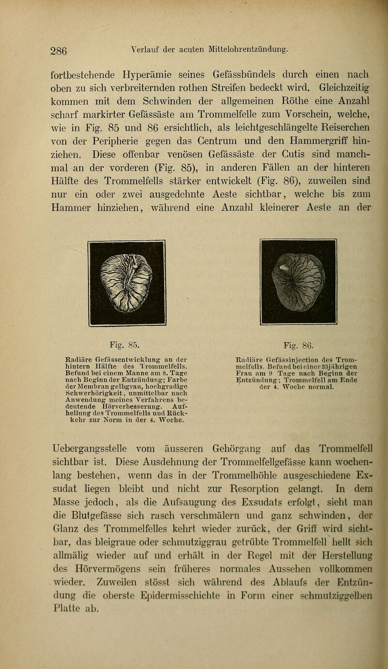 fortbestehende Hyperämie seines Gefässbündels durch einen nach oben zu sich verbreiternden rothen Streifen bedeckt wird. Gleichzeitig kommen mit dem Schwinden der allgemeinen Röthe eine Anzahl scharf markirter Gefässäste am Trommelfelle zum Vorschein, welche, wie in Fig. 85 und 86 ersichtlich, als leichtgeschlängelte Reiserchen von der Peripherie gegen das Gentrum und den Hammergriff hin- ziehen. Diese offenbar venösen Gefässäste der Cutis sind manch- mal an der vorderen (Fig. 85), in anderen Fällen an der hinteren Hälfte des Trommelfells stärker entwickelt (Fig. 86), zuweilen sind nur ein oder zwei ausgedehnte Aeste sichtbar, welche bis zum Hammer hinziehen, während eine Anzahl kleinerer Aeste an der Fig. 85. Radiäre Gefässentwicklung an der hintern Hälfte des Trommelfells. Befund bei einem Manne am 8. Tage nach Beginn der Entzündung; Farbe der Membran gelbgrau, hochgradige Schwerhörigkeit, unmittelbar nach Anwendung meines Verfahrens be- deutende Hörverbesserung. Auf- hellung1 des Trommelfells und Rück- kehr zur Norm in der 4. Woche. Fig. 86. Radiäre Gefässinjection des Trom- melfells. Befundbei einer 33jährigen Frau am 9 Tage nach Beginn der Entzündung; Trommelfell am Ende der 4. Woche normal. Uebergangsstelle vom äusseren Gehörgang auf das Trommelfell sichtbar ist. Diese Ausdehnung der Trommelfellgefässe kann wochen- lang bestehen, wenn das in der Trommelhöhle ausgeschiedene Ex- sudat liegen bleibt und nicht zur Resorption gelangt. In dem Masse jedoch, als die Aufsaugung des Exsudats erfolgt, sieht man die Blutgefässe sich rasch verschmälern und ganz schwinden, der Glanz des Trommelfelles kehrt wieder zurück, der Griff wird sicht- bar, das bleigraue oder schmutziggrau getrübte Trommelfell hellt sich allmälig wieder auf und erhält in der Regel mit der Herstellung des Hörvermögens sein früheres normales Aussehen vollkommen wieder. Zuweilen stösst sich während des Ablaufs der Entzün- dung die oberste Epidermisschichte in Form einer schmutziggelben Platte ab.