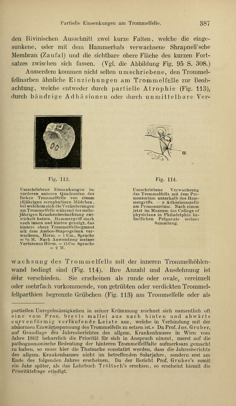 den Rivinischen Ausschnitt zwei kurze Falten, welche die einge- sunkene, oder mit dem Hammerhals verwachsene Shrapnell'sche Membran (Zaufal) und die sichtbare obere Fläche des kurzen Fort- satzes zwischen sich fassen. (Vgl. die Abbildung Fig. 95 S. 308.) Ausserdem kommen nicht selten umschriebene, den Trommel- fellnarben ähnliche Einziehungen am Trommelfelle zur Beob- achtung, welche entweder durch partielle Atrophie (Fig. 113), durch bändrige Adhäsionen oder durch unmittelbare Ver- '>■[ ■L -'■ H& M ' M mta* täM Fig. 113. Umschriebene Einsenkungen im vorderen unteren Quadranten des linken Trommelfells von einem 12jährigen scrophnlösen Mädchen, hei welchem sich die Veränderungen am Trommelfelle während der mehr- jährigen Krankenbeobachtung ent- wickelt hatten. Hammergriff stark nach innen und hinten geneigt, das hintere obere Trommeif'ellsegment mit dem Ambos-Stapesgelenk ver- wachsen. Hörm. = l Cm., Sprache = lfa M. Nach Anwendung meines Verfahrens Hörm. = 15 Cm Sprache = 2 M. Fig. 114. Umschriebene Verwachsung des Trommelfells mit dem Pro- montorium unterhalb des Ham- mergriffs. — a Adhäsionsstelle am Promontorium. Nach einem jetzt im Museum des College of physicians in Philadelphia be- findlichen Präparate meiner Sammlung. wachsung des Tromme 1 fe 11 s mit der inneren Trommelhöhlen- wand bedingt sind (Fig. 114). Ihre Anzahl und Ausdehnung ist sehr verschieden. Sie erscheinen als runde oder ovale, vereinzelt oder mehrfach vorkommende, von getrübten oder verdickten Trommel- fellparthien begrenzte Grübchen (Fig. 113) am Trommelfelle oder als partiellen Unregelmässigkeiten in seiner Krümmung zeichnet sich namentlich oft eine vom Proc. brevis mallei aus nach hinten und abwärts curven förmig verlaufende Leiste aus, welche in Verbindung mit der abnormen Einwärtsspannung des Trommelfells zu setzen ist.« Da Prof. Jos. Gruber, auf Grundlage des Jahresberichtes des allgem. Krankenhauses in Wien vom Jahre 1862 beharrlich die Priorität für sich in Anspruch nimmt, zuerst auf die pathognomonische Bedeutung der hinteren Trommelfellfalte aufmerksam gemacht zu haben, so muss hier die Thatsache constatirt werden, dass die Jahresberichte des allgem. Krankenhauses nicht im betreffenden Solarjahre, sondern erst am Ende des folgenden Jahres erscheinen. Da der Bericht Prof. Gruber's somit ein Jahr später, als das Lehrbuch Tröltsch's erschien, so erscheint hiemit die Prioritätsfrage erledigt.