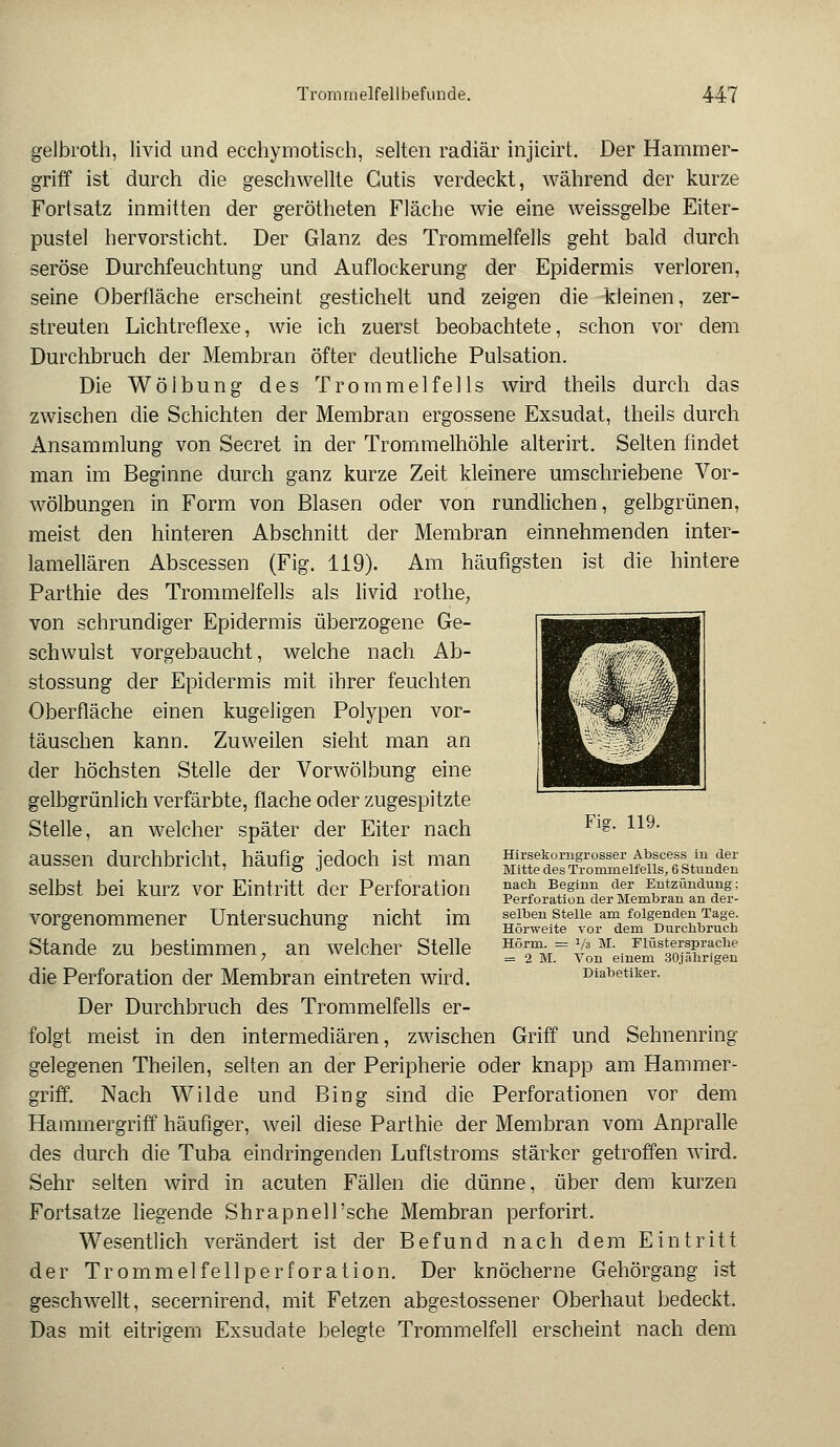 gelbroth, livid und ecchymotisch, selten radiär injicirt. Der Hammer- griff ist durch die gesell wellte Cutis verdeckt, während der kurze Fortsatz inmitten der gerötheten Fläche wie eine weissgelbe Eiter- pustel hervorsticht. Der Glanz des Trommelfells geht bald durch seröse Durchfeuchtung und Auflockerung der Epidermis verloren, seine Oberfläche erscheint gestichelt und zeigen die kleinen, zer- streuten Lichtreflexe, wie ich zuerst beobachtete, schon vor dem Durchbruch der Membran öfter deutliche Pulsation. Die Wölbung des Trommelfells wird theils durch das zwischen die Schichten der Membran ergossene Exsudat, theils durch Ansammlung von Secret in der Trommelhöhle alterirt. Selten findet man im Beginne durch ganz kurze Zeit kleinere umschriebene Vor- wölbungen in Form von Blasen oder von rundlichen, gelbgrünen, meist den hinteren Abschnitt der Membran einnehmenden inter- lamellären Abscessen (Fig. 119). Am häufigsten ist die hintere Parthie des Trommelfells als livid rothe, von schrundiger Epidermis überzogene Ge- schwulst vorgebaucht, welche nach Ab- stossung der Epidermis mit ihrer feuchten Oberfläche einen kugeligen Polypen vor- täuschen kann. Zuweilen sieht man an der höchsten Stelle der Vorwölbung eine gelbgrünlich verfärbte, flache oder zugespitzte Stelle, an welcher später der Eiter nach aussen durchbricht, häufig jedoch ist man selbst bei kurz vor Eintritt der Perforation vorgenommener Untersuchung nicht im Stande zu bestimmen; an welcher Stelle die Perforation der Membran eintreten wird. Der Durchbruch des Trommelfells er- folgt meist in den intermediären, zwischen Griff und Sehnenring gelegenen Theilen, selten an der Peripherie oder knapp am Hammer- griff. Nach Wilde und Bing sind die Perforationen vor dem Hammergriff häufiger, weil diese Parthie der Membran vom Anpralle des durch die Tuba eindringenden Luftstroms stärker getroffen wird. Sehr selten wird in acuten Fällen die dünne, über dem kurzen Fortsatze liegende Shrapnell'sche Membran perforirt. Wesentlich verändert ist der Befund nach dem Eintritt der Trommelfellperforation. Der knöcherne Gehörgang ist geschwellt, secernirend, mit Fetzen abgestossener Oberhaut bedeckt. Das mit eitrigem Exsudate belegte Trommelfell erscheint nach dem Fig. 119. Hirsekorngrosser Abscess in der Mitte des Trommelfells, 6 Stunden nach. Beginn der Entzündung; Perforation der Membran an der- selben Stelle am folgenden Tage. Hörweite vor dem Durchbruch Hörm. = 1M M. Flüsterspraclie = 2 M. Von einem 30jährigen Diabetiker.