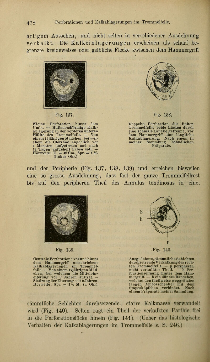 artigem Aussehen, und nicht selten in verschiedener Ausdehnung verkalkt. Die Kalkeinlagerungen erscheinen als scharf be- grenzte kreideweisse oder gelbliche Flecke zwischen dem Hammergriff . Fig. 137. Kleine Perforation hinter dem Umbo. — Halbmondförmige Kalk- ablagerung in der vorderen unteren Hälfte des Trommelfells. — Von einem 15jährigen Mädchen, bei wel- chem die Otorrhöe angeblich vor 4 Monaten aufgetreten und nach 14 Tagen aufgehört haben soll. — Hörweite: U. = 40Cm., Spr. = 4M. (linkes Ohr.) Fig. 138. Doppelte Perforation des linken Trommelfells, beide Lücken durch eine schmale Brücke getrennt; vor dem Hammergriff eine längliche Kalkablagerung. Nach einem in meiner Sammlung befindlichen Präparate. und der Peripherie (Fig. 137, 138, 139) und erreichen bisweilen eine so grosse Ausdehnung, dass fast der ganze Trommelfellrest bis auf den peripheren Theil des Annulus tendinosus in eine, Fig. 139. Centrale Perforation; vor und hinter dem Hammergriff umschriebene Kalkablagerungen im Trommel- felle. — Von einem 17jährigen Mäd- chen, bei welchem die Mittelohr- eiterung vor 8 Jahren auftrat. — Sistirung der Eiterung seit 2 Jahren. Hörweite: Spr. = U/u M. (r. Ohr). Ausgedehnte, sämmtliche Schichten durchsetzende Verkalkung des rech- ten Trommelfells. — p peripherer, nicht verkalkter Theil. — h Per- forationsöffnung hinter dem Ham- mergriff. — b ein dünnes Bändchen, welches den theilweise weggeätzten langen Ambosschenkel mit dem Stapesköpfchen verbindet. Nach einem Präparate meiner Sammlung. sämmtliche Schichten durchsetzende, starre Kalkmasse verwandelt wird (Fig. 140). Selten ragt ein Theil der verkalkten Parthie frei in die Perforationslücke hinein (Fig. 141). (Ueber das histologische Verhalten der Kalkablagerungen im Trommelfelle s. S. 246.)