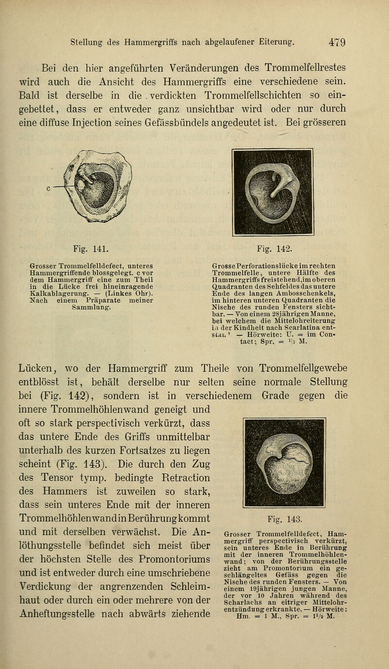 Bei den hier angeführten Veränderungen des Trommelfellrestes wird auch die Ansicht des Hammergriffs eine verschiedene sein. Bald ist derselbe in die . verdickten Trommelfellschichten so ein- gebettet, dass er entweder ganz unsichtbar wird oder nur durch eine diffuse Injection seines Gefässbündels angedeutet ist. Bei grösseren Fig. 141. Grosser Trornmelfelldefect, unteres Haniniergriffende blossgelegt. c vor dem Hammergriff eine zum Theil in die Lücke frei hineinragende Kalkablagerung. — (Linkes Ohr). Nach einem Präparate meiner Sammlung. Fig. 142. GrossePerforationslücke im rechten Trommelfelle, untere Hälfte des Hammergriffs freistehendem oberen Quadranten des Sehfeldes das untere Ende des langen Ambosschenkels, im hinteren unteren Quadranten die Nische des runden Fensters sicht- bar. — Von einem 28jährigen Manne, bei welchem die Mittelohreiterung i/i der Kindheit nach Scarlatina ent- Stau4 — Hörweite: U. = im Con- tact; Spr, = a|3 M. Lücken, wo der Hammergriff zum Theile von Trommelfellgewebe entblösst ist, behält derselbe nur selten seine normale Stellung bei (Fig. 142), sondern ist in verschiedenem Grade gegen die innere Trommelhöhlenwand geneigt und oft so stark perspectivisch verkürzt, dass das untere Ende des Griffs unmittelbar unterhalb des kurzen Fortsatzes zu liegen scheint (Fig. 443). Die durch den Zug des Tensor tymp. bedingte Retraction des Hammers ist zuweilen so stark, dass sein unteres Ende mit der inneren Trommelhöhlen wand in Berührun g kommt und mit derselben verwächst. Die An- löthungsstelle befindet sich meist über der höchsten Stelle des Promontoriums und ist entweder durch eine umschriebene Verdickung der angrenzenden Schleim- haut oder durch ein oder mehrere von der Anheftungsstelle nach abwärts ziehende Fig. 143. Grosser Trommelfelldefect, Ham- mergriff perspectivisch verkürzt, sein unteres Ende in Berührung mit der inneren Trommelhöhlen- wand ; von der Berührungsstelle zieht am Promontorium ein ge- schlängeltes Gefäss gegen die Nische des runden Fensters. — Von einem 19jährigen jungen Manne, der vor 10 Jahren während des Scharlachs an eitriger Mittelohr- entzündung erkrankte. — Hörweite: Hm. = 1 M., Spr. = l»/a M.