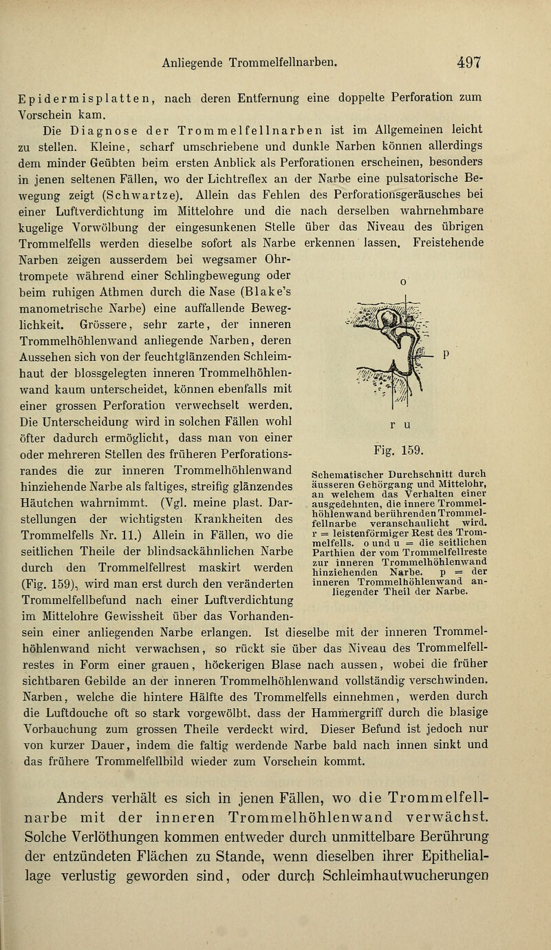 p Epidermisplatten, nach deren Entfernung eine doppelte Perforation zum Vorschein kam. Die Diagnose der Trommelfellnarben ist im Allgemeinen leicht zu stellen. Kleine, scharf umschriebene und dunkle Narben können allerdings dem minder Geübten beim ersten Anblick als Perforationen erscheinen, besonders in jenen seltenen Fällen, wo der Lichtreflex an der Narbe eine pulsatorische Be- wegung zeigt (Schwartze). Allein das Fehlen des Perforationsgeräusches bei einer Luftverdichtung im Mittelohre und die nach derselben wahrnehmbare kugelige Vorwölbung der eingesunkenen Stelle über das Niveau des übrigen Trommelfells werden dieselbe sofort als Narbe erkennen lassen. Freistehende Narben zeigen ausserdem bei wegsamer Ohr- trompete während einer Schlingbewegung oder beim ruhigen Athmen durch die Nase (Blake's manometrische Narbe) eine auffallende Beweg- lichkeit. Grössere, sehr zarte, der inneren Trommelhöhlenwand anliegende Narben, deren Aussehen sich von der feuchtglänzenden Schleim- haut der blossgelegten inneren Trommelhöhlen- wand kaum unterscheidet, können ebenfalls mit einer grossen Perforation verwechselt werden. Die Unterscheidung wird in solchen Fällen wohl öfter dadurch ermöglicht, dass man von einer oder mehreren Stellen des früheren Perforations- randes die zur inneren Trommelhöhlenwand hinziehende Narbe als faltiges, streifig glänzendes Häutchen wahrnimmt. (Vgl. meine plast. Dar- stellungen der wichtigsten Krankheiten des Trommelfells Nr. 11.) Allein in Fällen, wo die seitlichen Theile der blindsackähnlichen Narbe durch den Trommelfellrest maskirt werden (Fig. 159), wird man erst durch den veränderten Trommelfellbefund nach einer Luftverdichtung im Mittelohre Gewissheit über das Vorhanden- sein einer anliegenden Narbe erlangen. Ist dieselbe mit der inneren Trommel- höhlenwand nicht verwachsen, so rückt sie über das Niveau des Trommelfell- restes in Form einer grauen, höckerigen Blase nach aussen, wobei die früher sichtbaren Gebilde an der inneren Trommelhöhlenwand vollständig verschwinden. Narben, welche die hintere Hälfte des Trommelfells einnehmen, werden durch die Luftdouche oft so stark vorgewölbt, dass der Hammergriff durch die blasige Vorbauchung zum grossen Theile verdeckt wird. Dieser Befund ist jedoch nur von kurzer Dauer, indem die faltig werdende Narbe bald nach innen sinkt und das frühere Trommelfellbild wieder zum Vorschein kommt. Fig. 159. Schematischer Durchschnitt durch äusseren Gehörgang und. Mittelohr, an welchem das Verhalten einer ausgedehnten, die innere Trommel- höhlenwand berührenden Trommel- fellnarbe veranschaulicht wird. r = leistenförmiger Rest des Trom- melfells, o und u = die seitlichen Parthien der vom Trommelfellreste zur inneren Trommelhöhlenwand hinziehenden Narbe. p = der inneren Trommelhöhlenwand an- liegender Theil der Narbe. Anders verhält es sich in jenen Fällen, wo die Trommelfell- narbe mit der inneren Trommelhöhlenwand verwächst. Solche Verlöthungen kommen entweder durch unmittelbare Berührung der entzündeten Flächen zu Stande, wenn dieselben ihrer Epithelial- lage verlustig geworden sind, oder durch Schleimhautwucherungen