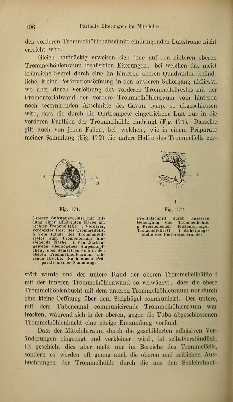 den vorderen Trommelhöhlenabschnitt eindringenden Luftstrome nicht erreicht wird. Gleich hartnäckig erweisen sich jene auf den hinteren oberen Trommelhöhlenraum localisirten Eiterungen, bei welchen das meist, krümliche Secret durch eine im hinteren oberen Quadranten befind- liche, kleine Perforationsöffnung in den äusseren Gehörgang abfliesst, wo aber durch Verlöthung des vorderen Trommelfellrestes mit der Promontorialwand der vordere Trommelhöhlenraum vom hinteren noch secernirenden Abschnitte des Cavum tymp. so abgeschlossen wird, dass die durch die Ohrtrompete eingetriebene Luft nur in die vorderen Parthien der Trommelhöhle eindringt (Fig. 171). Dasselbe gilt auch von jenen Fällen, bei welchen, wie in einem Präparate meiner Sammlung (Fig. 172) die untere Hälfte des Trommelfells zer- - h Fig. 171. Grosser Sübstanzverlust mit Bil- dung einer adhärenten Narbe am rechten Trommelfelle, v Vorderer, verdickter Rest des Trommelfeiis. h Vom Rande des Trommelfell- restes zum Promontorium hin- ziehende Narbe, s Von Narben- gewebe überzogenes Stapesköpf- chen, über demselben eine in den oberen Trommelhöhlenraum füh- rende Brücke. Nach einem Prä- parate meiner Sammlung. Frontalschnitt durch äusseren Gehörgang und Trommelhöhle, p Freistehender leistenförmiger Trommelfellrest. t Anheftungs- stelle des Perforationsrandes. stört wurde und der untere Rand der oberen Trommelfellhälfte t mit der inneren Trommelhöhlen wand so verwächst, dass die obere Trommelhöhlenbucht mit dem unteren Trommelhöhlenraum nur durch eine kleine Oeffnung über dem Steigbügel communicirt. Der untere, mit dem Tubencanal communicirende Trommelhöhlenraum war trocken, während sich in der oberen, gegen die Tuba abgeschlossenen Trommelhöhlenbucht eine eitrige Entzündung vorfand. Dass der Mittelohrraum durch die geschilderten adhäsiven Ver- änderungen eingeengt und verkleinert wird, ist selbstverständlich. Es geschieht dies aber nicht nur im Bereiche des Trommelfells, sondern es werden oft genug auch die oberen und seitlichen Aus- buchtungen der Trommelhöhle durch die aus den Schleimhaut-