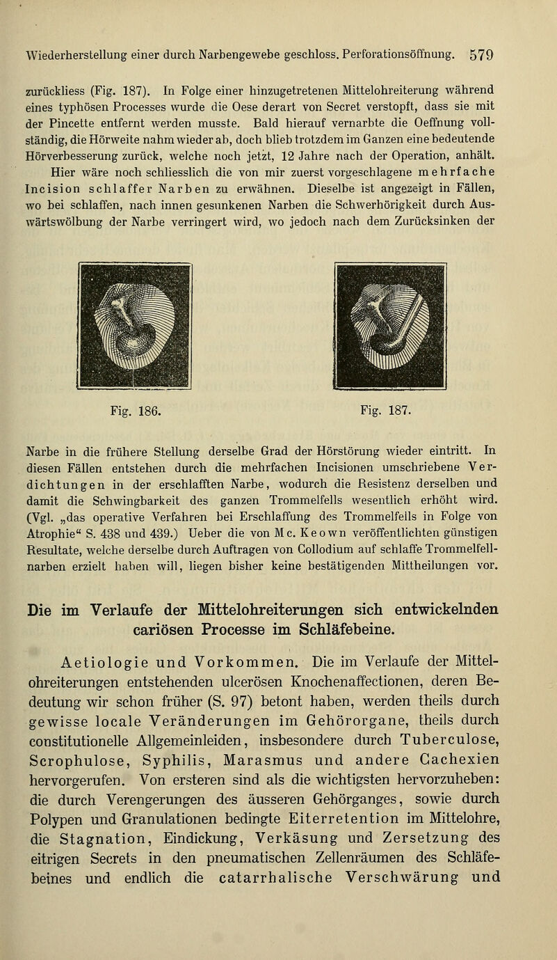 zurückliess (Fig. 187). In Folge einer hinzugetretenen Mittelohreiterung während eines typhösen Processes wurde die Oese derart von Secret verstopft, dass sie mit der Pincette entfernt werden musste. Bald hierauf vernarbte die Oeffnung voll- ständig, die Hörweite nahm wieder ab, doch blieb trotzdem im Ganzen eine bedeutende Hörverbesserung zurück, welche noch jetzt, 12 Jahre nach der Operation, anhält. Hier wäre noch schliesslich die von mir zuerst vorgeschlagene mehrfache Incision schlaffer Narben zu erwähnen. Dieselbe ist angezeigt in Fällen, wo bei schlaffen, nach innen gesunkenen Narben die Schwerhörigkeit durch Aus- wärtswölbung der Narbe verringert wird, wo jedoch nach dem Zurücksinken der Fig. 186. Fig. 187. Narbe in die frühere Stellung derselbe Grad der Hörstörung wieder eintritt. In diesen Fällen entstehen durch die mehrfachen Incisionen umschriebene Ver- dichtungen in der erschlafften Narbe, wodurch die Resistenz derselben und damit die Schwingbarkeit des ganzen Trommelfells wesentlich erhöht wird. (Vgl. „das operative Verfahren bei Erschlaffung des Trommelfells in Folge von Atrophie S. 438 und 439.) Ueber die von Mc. Keown veröffentlichten günstigen Resultate, welche derselbe durch Auftragen von Collodium auf schlaffe Trommelfell- narben erzielt haben will, liegen bisher keine bestätigenden Mittheilungen vor. Die im Verlaufe der Mittelohreiterungen sich entwickelnden cariösen Processe im Schläfebeine. Aetiologie und Vorkommen. Die im Verlaufe der Mittel- ohreiterungen entstehenden ulcerösen Knochenaffectionen, deren Be- deutung wir schon früher (S. 97) betont haben, werden theils durch gewisse locale Veränderungen im Gehörorgane, theils durch constitutionelle Allgemeinleiden, insbesondere durch Tuberculose, Scrophulose, Syphilis, Marasmus und andere Gachexien hervorgerufen. Von ersteren sind als die wichtigsten hervorzuheben: die durch Verengerungen des äusseren Gehörganges, sowie durch Polypen und Granulationen bedingte Eiterretention im Mittelohre, die Stagnation, Eindickung, Verkäsung und Zersetzung des eitrigen Secrets in den pneumatischen Zellenräumen des Schläfe- beines und endlich die catarrhalische Verschwärung und