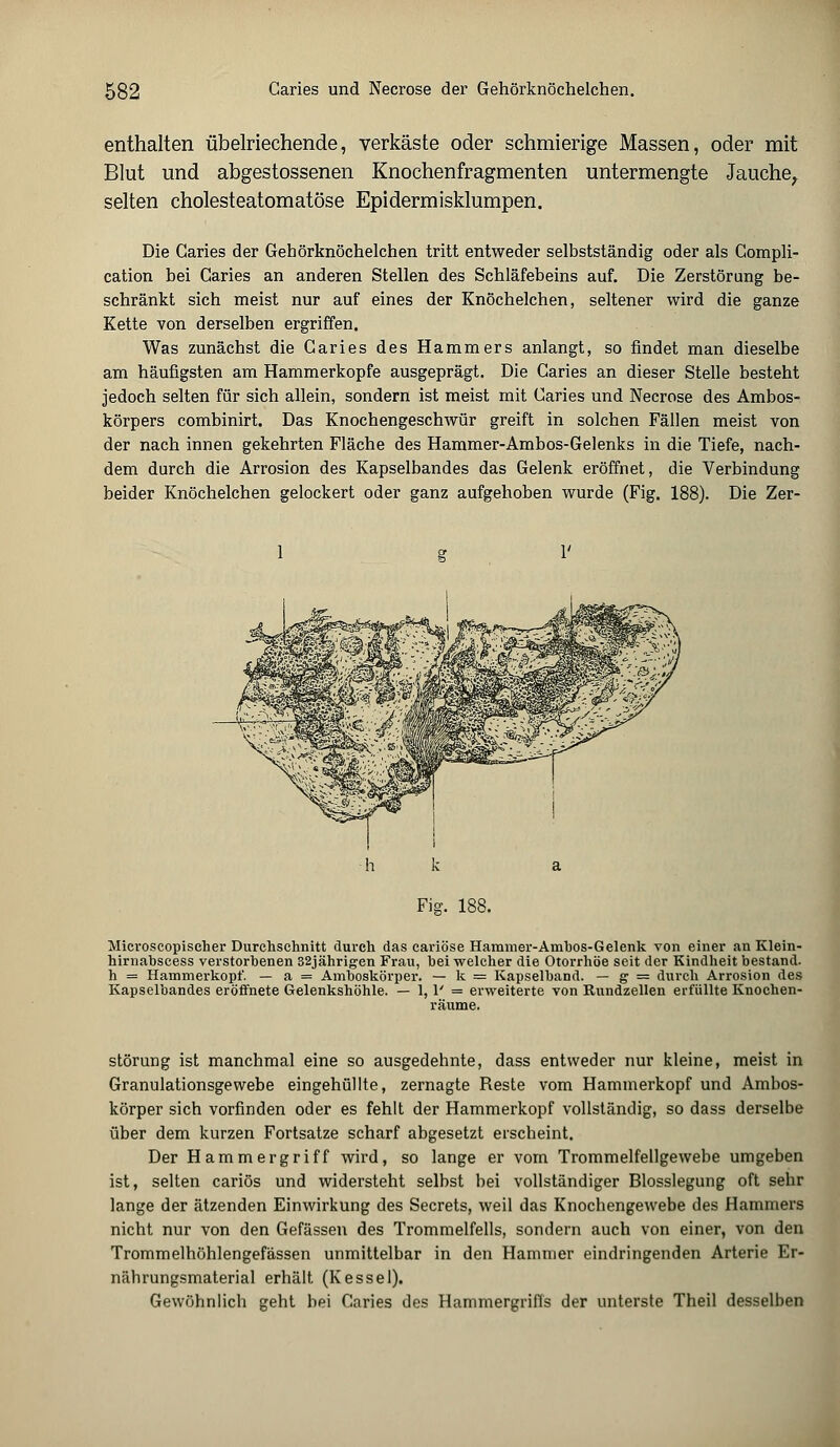 enthalten übelriechende, verkäste oder schmierige Massen, oder mit Blut und abgestossenen Knochenfragmenten untermengte Jauche, selten cholesteatomatöse Epidermisklumpen. Die Caries der Gehörknöchelchen tritt entweder selbstständig oder als Compli- cation bei Caries an anderen Stellen des Schläfebeins auf. Die Zerstörung be- schränkt sich meist nur auf eines der Knöchelchen, seltener wird die ganze Kette von derselben ergriffen. Was zunächst die Caries des Hammers anlangt, so findet man dieselbe am häufigsten am Hammerkopfe ausgeprägt. Die Caries an dieser Stelle besteht jedoch selten für sich allein, sondern ist meist mit Caries und Necrose des Ambos- körpers combinirt. Das Knochengeschwür greift in solchen Fällen meist von der nach innen gekehrten Fläche des Hammer-Ambos-Gelenks in die Tiefe, nach- dem durch die Arrosion des Kapselbandes das Gelenk eröffnet, die Verbindung beider Knöchelchen gelockert oder ganz aufgehoben wurde (Fig. 188). Die Zer- 1 1; Fig. 188. Microseopischer Durchschnitt durch das cariöse Hammer-Ambos-Gelenk von einer an Klein- hirnabscess verstorbenen 32jähri<ren Frau, bei welcher die Otorrhöe seit der Kindheit bestand, h = Hammerkopf. — a = Amboskörper. — k = Kapselband. — g = durch Arrosion des Kapselbandes eröffnete Gelenkshöhle. — 1, 1' = erweiterte von Rundzellen erfüllte Knochen- räume. Störung ist manchmal eine so ausgedehnte, dass entweder nur kleine, meist in Granulationsgewebe eingehüllte, zernagte Reste vom Hammerkopf und Ambos- körper sich vorfinden oder es fehlt der Hammerkopf vollständig, so dass derselbe über dem kurzen Fortsatze scharf abgesetzt erscheint. Der Hammergriff wird, so lange er vorn Trommelfellgewebe umgeben ist, selten cariös und widersteht selbst bei vollständiger Blosslegung oft sehr lange der ätzenden Einwirkung des Secrets, weil das Knochengewebe des Hammers nicht nur von den Gefässen des Trommelfells, sondern auch von einer, von den Trommelhöhlengefässen unmittelbar in den Hammer eindringenden Arterie Er- nährungsmaterial erhält (Kessel). Gewöhnlich geht bei Caries des Hammergriffs der unterste Theil desselben