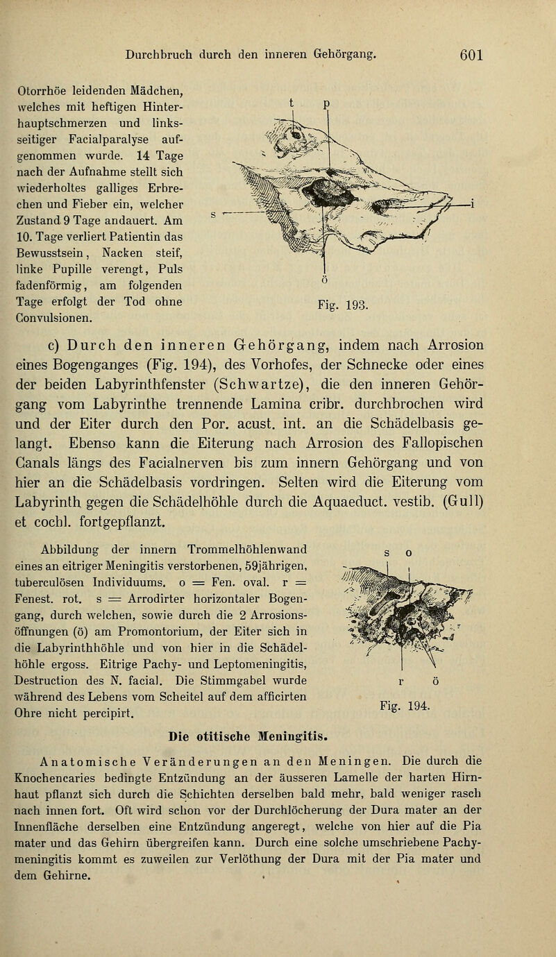 Otorrhöe leidenden Mädchen, welches mit heftigen Hinter- hauptschmerzen und links- seitiger Facialparalyse auf- genommen wurde. 14 Tage nach der Aufnahme stellt sich wiederholtes galliges Erbre- chen und Fieber ein, welcher Zustand 9 Tage andauert. Am 10. Tage verliert Patientin das Bewusstsein, Nacken steif, linke Pupille verengt, Puls fadenförmig, am folgenden Tage erfolgt der Tod ohne Convulsionen. Fig. 193. c) Durch den inneren Grehörgang, indem nach Arrosion eines Bogenganges (Fig. 194), des Vorhofes, der Schnecke oder eines der beiden Labyrinthfenster (Schwartze), die den inneren Gehör- gang vom Labyrinthe trennende Lamina cribr. durchbrochen wird und der Eiter durch den Por. acust. int. an die Schädelbasis ge- langt. Ebenso kann die Eiterung nach Arrosion des Fallopischen Ganais längs des Facialnerven bis zum innern Gehörgang und von hier an die Schädelbasis vordringen. Selten wird die Eiterung vom Labyrinth gegen die Schädelhöhle durch die Aquaeduct. vestib. (Gull) et cochl. fortgepflanzt. Abbildung der innern Trommelhöhlenwand s 0 eines an eitriger Meningitis verstorbenen, 59jährigen, tuberculösen Individuums, o = Fen. oval, r = Fenest. rot. s = Arrodirter horizontaler Bogen- gang, durch welchen, sowie durch die 2 Arrosions- öffnungen (ö) am Promontorium, der Eiter sich in die Labyrinthhöhle und von hier in die Schädel- höhle ergoss. Eitrige Pachy- und Leptomeningitis, Destruction des N. facial. Die Stimmgabel wurde während des Lebens vom Scheitel auf dem afficirten Ohre nicht percipirt. Die otitische Meningitis. Anatomische Veränderungen an den Meningen. Die durch die Knochencaries bedingte Entzündung an der äusseren Lamelle der harten Hirn- haut pflanzt sich durch die Schichten derselben bald mehr, bald weniger rasch nach innen fort. Oft wird schon vor der Durchlöcherung der Dura mater an der Innenfläche derselben eine Entzündung angeregt, welche von hier auf die Pia mater und das Gehirn übergreifen kann. Durch eine solche umschriebene Pachy- meningitis kommt es zuweilen zur Verlöthung der Dura mit der Pia mater und dem Gehirne.