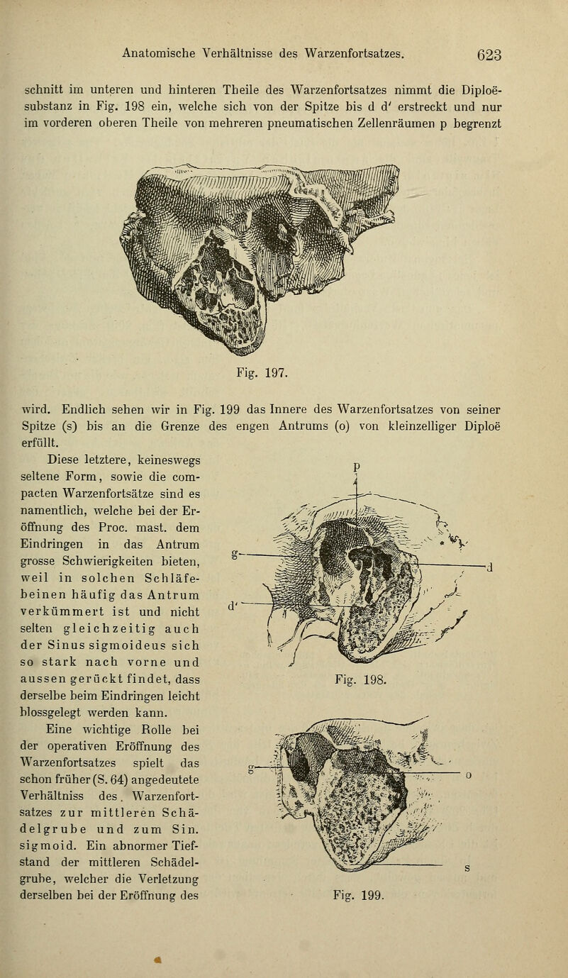 schnitt im unteren und hinteren Theile des Warzenfortsatzes nimmt die Diploe- substanz in Fig. 198 ein, welche sich von der Spitze bis d d' erstreckt und nur im vorderen oberen Theile von mehreren pneumatischen Zellenräumen p begrenzt Fig. 197. d'- wird. Endlich sehen wir in Fig. 199 das Innere des Warzenfortsatzes von seiner Spitze (s) bis an die Grenze des engen Antrums (o) von kleinzelliger Diploe erfüllt. Diese letztere, keineswegs seltene Form, sowie die com- pacten Warzenfortsätze sind es namentlich, welche bei der Er- öffnung des Proc. mast. dem Eindringen in das Antrum grosse Schwierigkeiten bieten, weil in solchen Schläfe- beinen häufig das Antrum verkümmert ist und nicht selten gleichzeitig auch der Sinus sigmoideus sich so stark nach vorne und aussen gerückt findet, dass derselbe beim Eindringen leicht blossgelegt werden kann. Eine wichtige Rolle bei der operativen Eröffnung des Warzenfortsatzes spielt das schon früher (S. 64) angedeutete Verhältniss des. Warzenfort- satzes zur mittleren Schä- delgrube und zum Sin. sigmoid. Ein abnormer Tief- stand der mittleren Schädel- grube, welcher die Verletzung derselben bei der Eröffnung des Fig. 198. Fisr. 199.