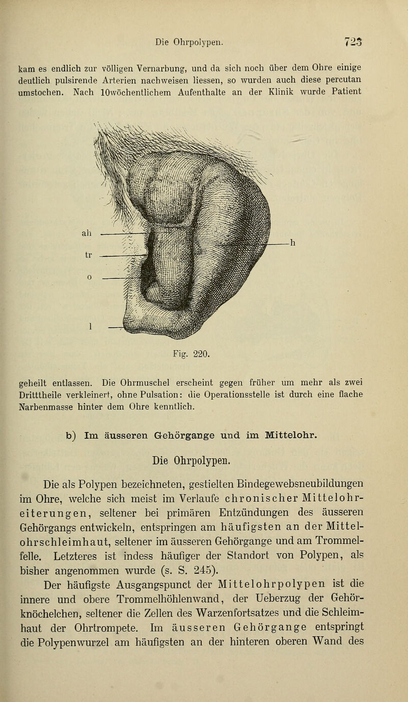 kam es endlich zur völligen Vernarbung, und da sich noch über dem Ohre einige deutlich pulsirende Arterien nachweisen Hessen, so wurden auch diese percutan umstochen. Nach IOwöchentlichem Aufenthalte an der Klinik wurde Patient Fig. 220. geheilt entlassen. Die Ohrmuschel erscheint gegen früher um mehr als zwei Dritttheile verkleinert, ohne Pulsation: die Operationsstelle ist durch eine flache Narbenmasse hinter dem Ohre kenntlich. b) Im äusseren Gehörgange und im Mittelohr. Die Ohrpolypen. Die als Polypen bezeichneten, gestielten Bindegewebsneubildungen im Ohre, welche sich meist im Verlaufe chronischer Mittelohr- eiterungen, seltener bei primären Entzündungen des äusseren Gehörgangs entwickeln, entspringen am häufigsten an der Mittel- ohrschleimhaut, seltener im äusseren Gehörgange und am Trommel- felle. Letzteres ist indess häufiger der Standort von Polypen, als bisher angenommen wurde (s. S. 245). Der häufigste Ausgangspunct der Mittelohrpolypen ist die innere und obere Trommelhöhlenwand, der Ueberzug der Gehör- knöchelchen, seltener die Zellen des Warzenfortsatzes und die Schleim- haut der Ohrtrompete. Im äusseren Gehörgange entspringt die Polypenwurzel am häufigsten an der hinteren oberen Wand des