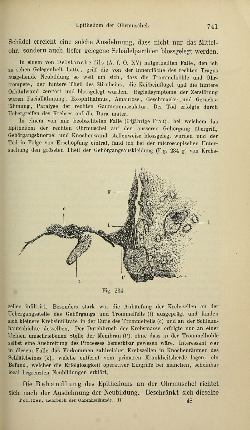 Schädel erreicht eine solche Ausdehnung, dass nicht nur das Mittel- ohr, sondern auch tiefer gelegene Schädelparthien blossgelegt werden. In einem von Delstanche fils (A. f. 0. XV) mitgetheilten Falle, den ich zu sehen Gelegenheit hatte, griff die von der Innenfläche des rechten Tragus ausgehende Neubildung so weit um sich, dass die Trommelhöhle und Ohr- trompete, der hintere Theil des Stirnbeins, die Kei'beinflügel und die hintere Orbitalwand zerstört und blossgelegt wurden. Begleitsymptome der Zerstörung waren Faciallähmung, Exophthalmus, Amaurose, Geschmacks- und Geruchs- lähmung, Paralyse der rechten Gaumenmusculatur. Der Tod erfolgte durch Uebergreifen des Krebses auf die Dura mater. In einem von mir beobachteten Falle (64jährige Frau), bei welchem das Epitheliom der rechten Ohrmuschel auf den äusseren Gehörgang übergriff, Gehörgangsknorpel und Knochenwand stellenweise blossgelegt wurden und der Tod in Folge von Erschöpfung eintrat, fand ich bei der microscopischen Unter- suchung den grössten Theil der Gehörgangsauskleidung (Fig. 234 g) von Krebs- - k Fig. 234. zellen infiltrirt. Besonders stark war die Anhäufung der Krebszellen an der Uebergangsstelle des Gehörgangs und Trommelfells (t) ausgeprägt und fanden sich kleinere Krebsinfiltrate in der Cutis des Trommelfells (c) und an der Schleim- hautschichte desselben. Der Durchbruch der Krebsmasse erfolgte nur an einer kleinen umschriebenen Stelle der Membran (f), ohne dass in der Trommelhöhle selbst eine Ausbreitung des Processes bemerkbar gewesen wäre. Interessant war in diesem Falle das Vorkommen zahlreicher Krebszellen in Knochenräumen des Schläfebeines (k), welche entfernt vom primären Krankheitsherde lagen, ein Befund, welcher die Erfolglosigkeit operativer Eingriffe bei manchen, scheinbar local begrenzten Neubildungen erklärt. Die Behandlung des Epithelioms an der Ohrmuschel richtet sich nach der Ausdehnung der Neubildung. Beschränkt sich dieselbe Politzer, Lehrbuch der Ohrenheilkunde. II. 48