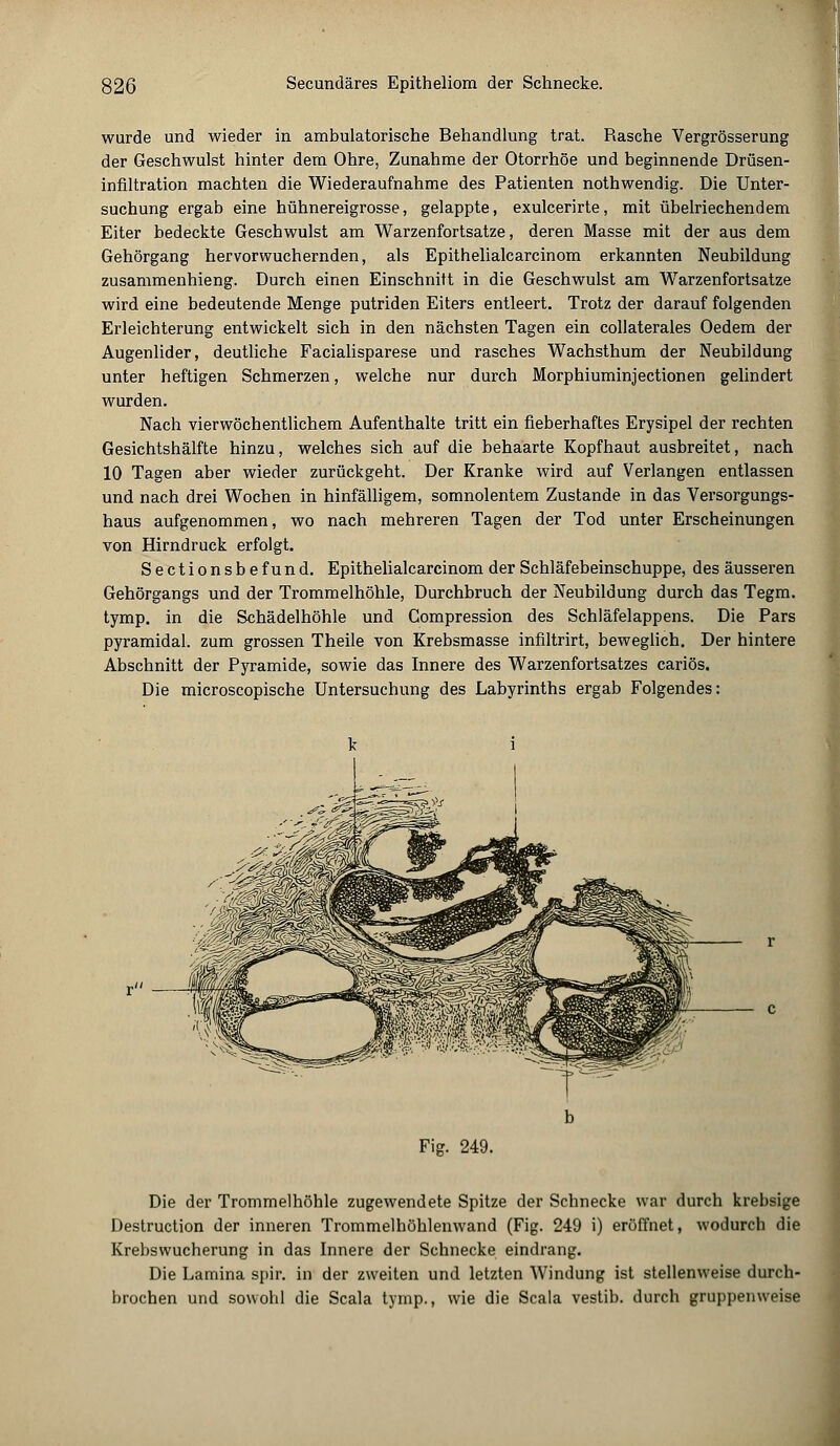 wurde und wieder in ambulatorische Behandlung trat. Rasche Vergrösserung der Geschwulst hinter dem Ohre, Zunahme der Otorrhöe und beginnende Drüsen- infiltration machten die Wiederaufnahme des Patienten nothwendig. Die Unter- suchung ergab eine hühnereigrosse, gelappte, exulcerirte, mit übelriechendem Eiter bedeckte Geschwulst am Warzenfortsatze, deren Masse mit der aus dem Gehörgang hervorwuchernden, als Epithelialcarcinom erkannten Neubildung zusammenhieng. Durch einen Einschnitt in die Geschwulst am Warzenfortsatze wird eine bedeutende Menge putriden Eiters entleert. Trotz der darauf folgenden Erleichterung entwickelt sich in den nächsten Tagen ein collaterales Oedem der Augenlider, deutliche Facialisparese und rasches Wachsthum der Neubildung unter heftigen Schmerzen, welche nur durch Morphiuminjectionen gelindert wurden. Nach vierwöchentlichem Aufenthalte tritt ein fieberhaftes Erysipel der rechten Gesichtshälfte hinzu, welches sich auf die behaarte Kopfhaut ausbreitet, nach 10 Tagen aber wieder zurückgeht. Der Kranke wird auf Verlangen entlassen und nach drei Wochen in hinfälligem, somnolentem Zustande in das Versorgungs- haus aufgenommen, wo nach mehreren Tagen der Tod unter Erscheinungen von Hirndruck erfolgt. Sectionsbefund. Epithelialcarcinom der Schläfebeinschuppe, des äusseren Gehörgangs und der Trommelhöhle, Durchbruch der Neubildung durch das Tegm. tymp. in die Schädelhöhle und Compression des Schläfelappens. Die Pars pyramidal, zum grossen Theile von Krebsmasse infiltrirt, beweglich. Der hintere Abschnitt der Pyramide, sowie das Innere des Warzenfortsatzes cariös. Die microscopische Untersuchung des Labyrinths ergab Folgendes: Fig. 249. Die der Trommelhöhle zugewendete Spitze der Schnecke war durch krebsige Destruction der inneren Trommelhöhlenwand (Fig. 249 i) eröffnet, wodurch die Krebswucherung in das Innere der Schnecke eindrang. Die Lamina spir. in der zweiten und letzten Windung ist stellenweise durch- brochen und sowohl die Scala tymp., wie die Scala vestib. durch gruppenweise