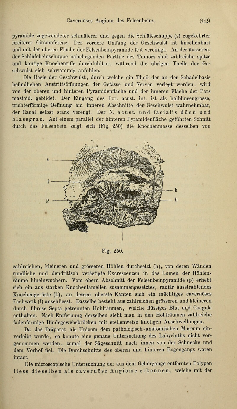Pyramide zugewendeter schmälerer und gegen die Schläfeschuppe (s) zugekehrter breiterer Gircumferenz. Der vordere Umfang der Geschwulst ist knochenhart und mit der oberen Fläche der Felsenbeinpyramide fest vereinigt. An der äusseren, der Schläfebeinschuppe naheliegenden Parthie des Tumors sind zahlreiche spitze und kantige Knochenriffe durchfühlbar, während die übrigen Theile der Ge- schwulst sich schwammig anfühlen. Die Basis der Geschwulst, durch welche ein Theil der an der Schädelbasis befindlichen Austrittsöffnungen der Gefässe und Nerven verlegt werden, wird von der oberen und hinteren Pyramidenfläche und der inneren Fläche der Pars mastoid. gebildet. Der Eingang des Por. acust. int. ist als halblinsengrosse, trichterförmige Oeffnung am inneren Abschnitte der Geschwulst wahrnehmbar, der Canal selbst stark verengt. Der N. acust. und facialis dünn und blassgrau. Auf einem parallel der hinteren Pyramidenfläche geführten Schnitt durch das Felsenbein zeigt sich (Fig. 250) die Knochenmasse desselben von Fig. 250. zahlreichen, kleineren und grösseren Höhlen durchsetzt (h), von deren Wänden rundliche und dendritisch verästigte Excrescenzen in das Lumen der Höhlen- räume hineinwuchern. Vom obern Abschnitt der Felsenbeinpyramide (p) erhebt sich ein aus starken Knochenlamellen zusammengesetztes, radiär ausstrahlendes Knochengerüste (k), an dessen oberste Kanten sich ein mächtiges cavernöses Fachwerk (f) anschliesst. Dasselbe besteht aus zahlreichen grösseren und kleineren durch fibröse Septa getrennten Hohlräumen, welche flüssiges Blut und Coagula enthalten. Nach Entfernung derselben sieht man in den Hohlräumen zahlreiche fadenförmige Bindegewebsbrücken mit stellenweise knotigen Anschwellungen. Da das Präparat als Unicum dem pathologisch-anatomischen Museum ein- verleibt wurde, so konnte eine genaue Untersuchung des Labyrinths nicht vor- genommen werden, zumal der Sägeschnitt nach innen von der Schnecke und dem Vorhof fiel. Die Durchschnitte des oberen und hinteren Bogengangs waren intact. Die microscopische Untersuchung der aus dem Gehörgange entfernten Polypen liess dieselben als cavernöse Angiome erkennen, welche mit der