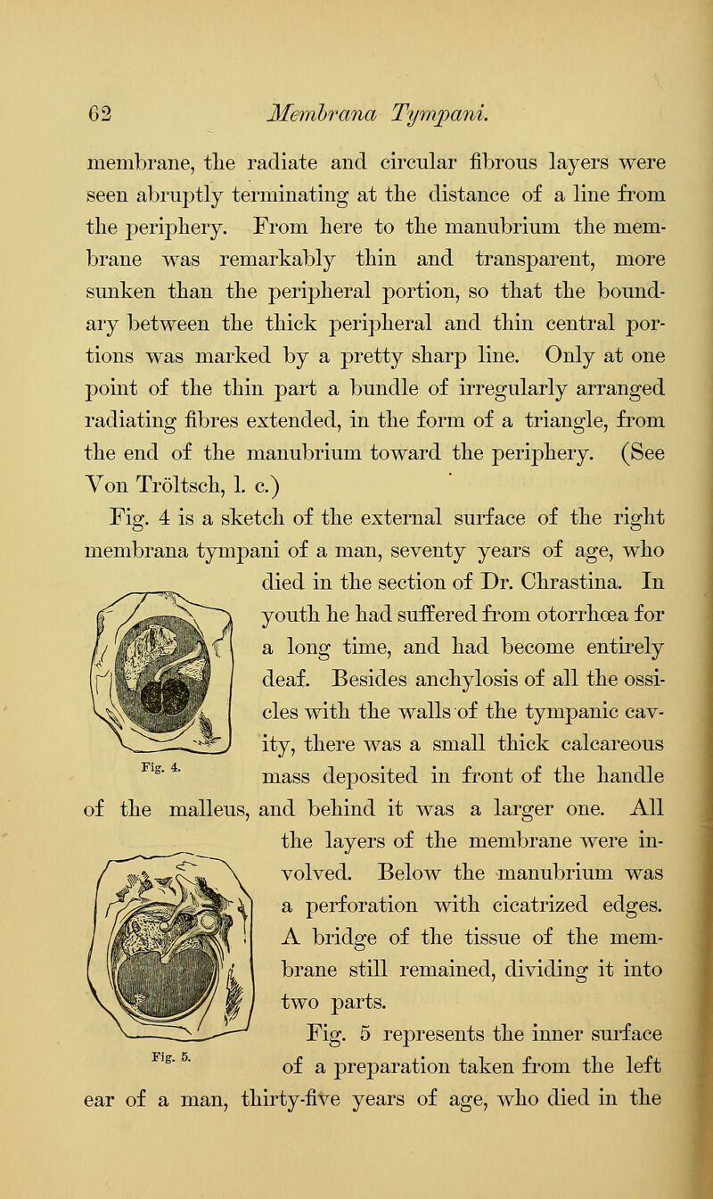 membrane, the radiate and circular fibrous layers were seen abruptly terminating at the distance of a line from the periphery. From here to the manubrium the mem- brane was remarkably thin and transparent, more sunken than the peripheral portion, so that the bound- ary between the thick peripheral and thin central por- tions was marked by a pretty sharp line. Only at one point of the thin part a bundle of irregularly arranged radiating fibres extended, in the form of a triangle, from the end of the manubrium toward the periphery. (See Yon Troltsch, 1. c.) Fig. 4 is a sketch of the external surface of the right membrana tympani of a man, seventy years of age, who died in the section of Dr. Chrastina. In youth he had suffered from otorrhoea for a long time, and had become entirely deaf. Besides anchylosis of all the ossi- cles with the walls of the tympanic cav- ity, there was a small thick calcareous mass deposited in front of the handle of the malleus, and behind it was a larger one. All the layers of the membrane were in- volved. Below the -manubrium was a perforation with cicatrized edges. A bridge of the tissue of the mem- brane still remained, dividing it into two parts. Fig. 5 represents the inner surface of a preparation taken from the left ear of a man, thirty-five years of age, who died in the Fig. 4. Fig. 5.
