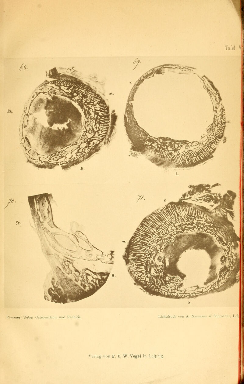 Tafel V! Pommer, Ueber Osteomalacie und Rachitis. Lichtdruck von A. Naumann & Schroeder, Lei Verlag von F. C. W. Vogel in Leipzig.