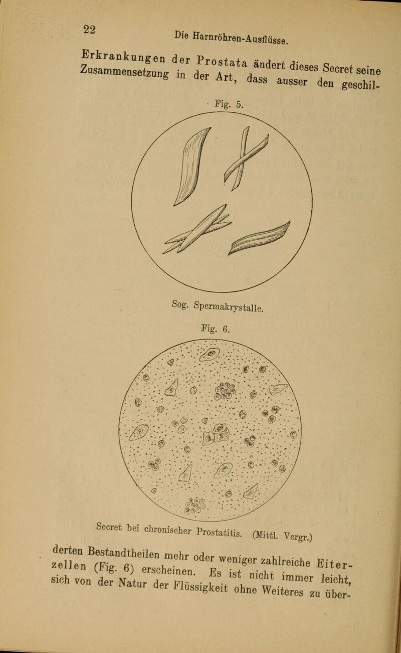 Erk Die Harnröhren-Ausflüsse. rankungen der Prostata ändert dieses Wt ■ Zusammensetzung in der Art a Cretseme 8 n aer Art, dass ausser den gesehil- Fig. 5. Sog. Spermakrystalle. Kg. 6. Secret bei chronischer Prestatitis. (Mittl. Vergr.)