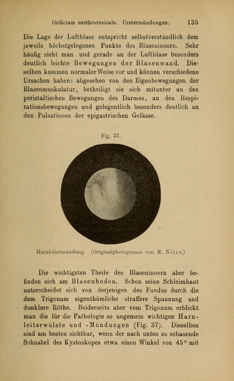 Die Lage der Luftblase entspricht selbstverständlich dem jeweils höchstgelegenen Punkte des ßlaseninnern. Sehr häufig sieht man und gerade an der Luftblase besonders deutlich leichte Bewegungen der Blasenwand. Die- selben kommen normalerweise vor und können verschiedene Ursachen haben: abgesehen von den Eigenbewegungen der Blasenmuskulatur, betheiligt sie sich mitunter an den peristaltischen Bewegungen des Darmes, an den ßespi- rationsbewegungen und gelegentlich besonders deutlich an den Pulsationen der epigastrischen Gefässe. Fig. 37. Harn leitermiin düng. (Üriginalphotogranmi von M. Nitze.) Die wichtigsten Theile des Blaseninnern aber be- finden sich am Blasenboden. Schon seine Schleimhaut unterscheidet sich von derjenigen des Fundus durch die dem Trigonum eigenthümliche straflere Spannung und dunklere ßöthe. Beiderseits aber vom Trigonum erblickt man die für die Pathologie so ungemein wichtigen Harn- leiterwülste und -Mündungen (Fig. 37). Dieselben sind am besten sichtbar, wenn der nach unten zu schauende Schnabel des Kystoskopes etwa einen Winkel von 45 ° mit