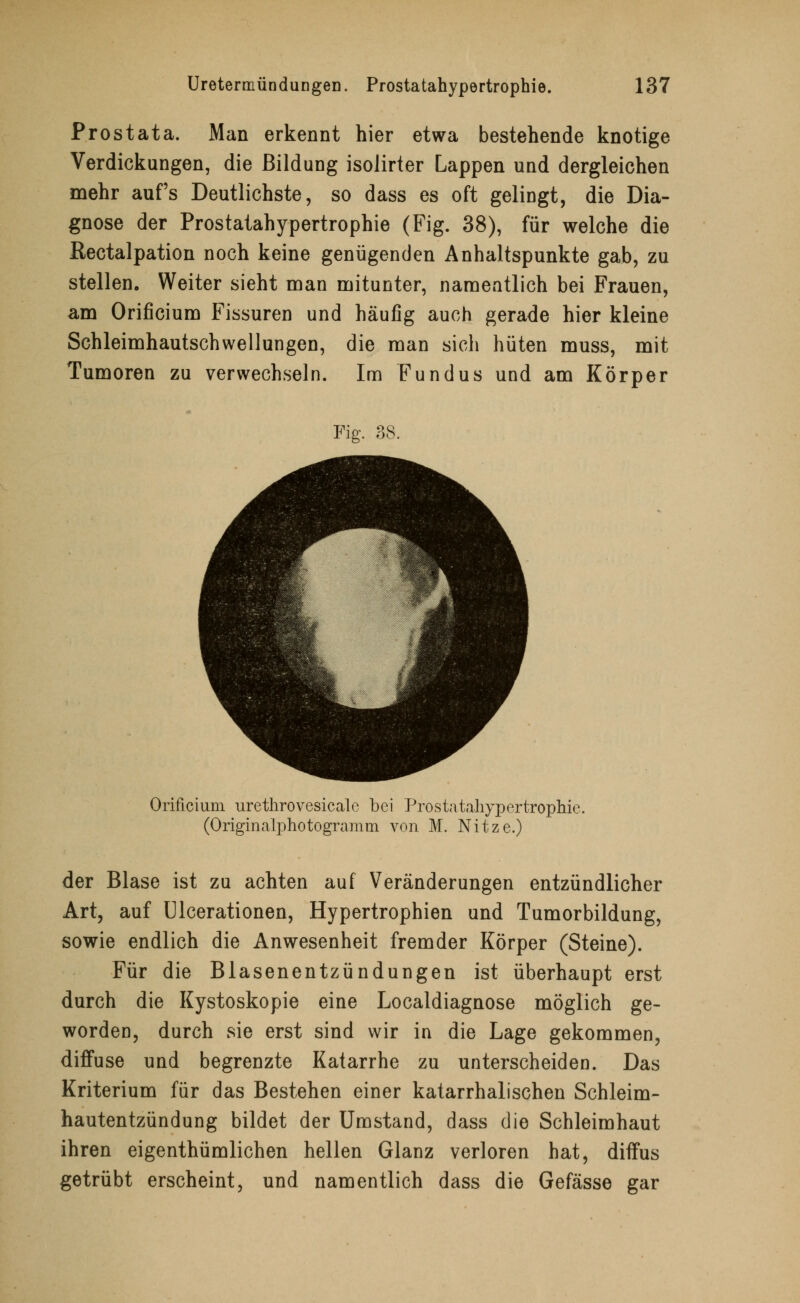 Prostata. Man erkennt hier etwa bestehende knotige Verdickungen, die Bildung isolirter Lappen und dergleichen mehr aufs Deutlichste, so dass es oft gelingt, die Dia- gnose der Prostatahypertrophie (Fig. 38), für welche die Rectalpation noch keine genügenden Anhaltspunkte gab, zu stellen. Weiter sieht man mitunter, namentlich bei Frauen, am Orificium Fissuren und häufig auch gerade hier kleine Schleimhautschwellungen, die man sich hüten muss, mit Tumoren zu verwechseln. Im Fundus und am Körper Fig. 38. Orificium urethrovesicale bei Prostatahypertrophie. (Originalphotogramm von M. Nitze.) der Blase ist zu achten auf Veränderungen entzündlicher Art, auf Ulcerationen, Hypertrophien und Tumorbildung, sowie endlich die Anwesenheit fremder Körper (Steine). Für die Blasenentzündungen ist überhaupt erst durch die Kystoskopie eine Localdiagnose möglich ge- worden, durch sie erst sind wir in die Lage gekommen, diffuse und begrenzte Katarrhe zu unterscheiden. Das Kriterium für das Bestehen einer katarrhalischen Schleim- hautentzündung bildet der Umstand, dass die Schleimhaut ihren eigenthümlichen hellen Glanz verloren hat, diffus getrübt erscheint, und namentlich dass die Gefässe gar