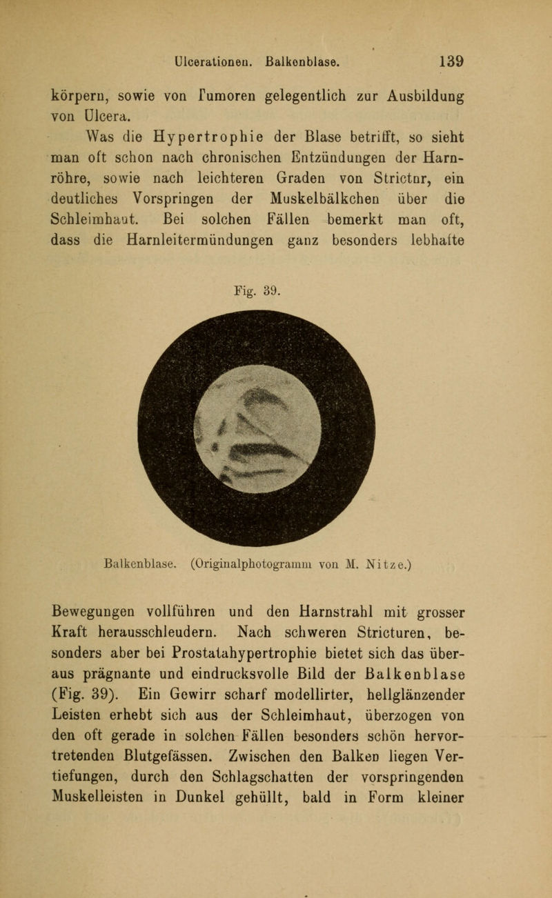 körpern, sowie von Tumoren gelegentlich zur Ausbildung von ülcera. Was die Hypertrophie der Blase betrifft, so sieht man oft schon nach chronischen Entzündungen der Harn- röhre, sowie nach leichteren Graden von Strictnr, ein deutliches Vorspringen der Muskelbälkchen über die Schleimhaut. Bei solchen Fällen bemerkt man oft, dass die Harnleitermündungen ganz besonders lebhafte Fig. 39. Balkenblase, (Originalphotogramm von M. Nitze.) Bewegungen vollführen und den Harnstrahl mit grosser Kraft herausschleudern. Nach schweren Stricturen, be- sonders aber bei Prostatahypertrophie bietet sich das über- aus prägnante und eindrucksvolle Bild der Balken blase (Fig. 39). Ein Gewirr scharf modellirter, hellglänzender Leisten erhebt sich aus der Schleimhaut, überzogen von den oft gerade in solchen Fällen besonders schön hervor- tretenden Blutgefässen. Zwischen den Balken liegen Ver- tiefungen, durch den Schlagschatten der vorspringenden Muskelleisten in Dunkel gehüllt, bald in Form kleiner