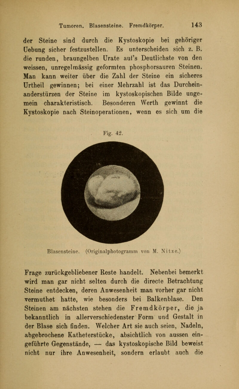 der Steine sind durch die Kystoskopie bei gehöriger Uebung sicher festzustellen. Es unterscheiden sich z. B. die runden, braungelben Urate auf's Deutlichste von den weissen, unregelmassig geformten phosphorsauren Steinen. Man kann weiter über die Zahl der Steine ein sicheres Urtheil gewinnen; bei einer Mehrzahl ist das Durchein- anderstürzen der Steine im kystoskopischen Bilde unge- mein charakteristisch. Besonderen Werth gewinnt die Kystoskopie nach Steinoperationen, wenn es sich um die Fig. 42. Blasensteine. (Originalphotogramm von M. Nitze.) Frage zurückgebliebener Reste handelt. Nebenbei bemerkt wird man gar nicht selten durch die directe Betrachtung Steine entdecken, deren Anwesenheit man vorher gar nicht vermuthet hatte, wie besonders bei Balkenblase. Den Steinen am nächsten stehen die Fremdkörper, die ja bekanntlich in allerverschiedenster Form und Gestalt in der Blase sich finden. Welcher Art sie auch seien, Nadeln, abgebrochene Katheterstücke, absichtlich von aussen ein- geführte Gegenstände, — das kystoskopische Bild beweist nicht nur ihre Anwesenheit, sondern erlaubt auch die