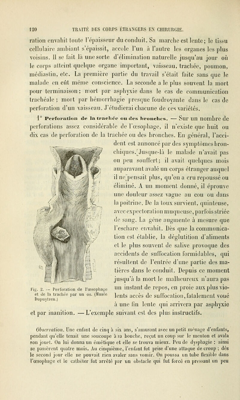 ration envahit toute l'épaisseur du conduit. Sa marche est lente ; le tissu cellulaire ambiant s'épaissit, accole l'un à l'autre les organes les plus voisins. Il se fait là une sorte d'élimination naturelle jusqu'au jour où le corps atteint quelque organe important, vaisseau, trachée, poumon, médiastin, etc. La première partie du travail s'était faite sans que le malade en eût même conscience. La seconde a le plus souvent la mort pour terminaison ; mort par asphyxie dans le cas de communication trachéale ; mort par hémorrhagie presque foudroyante dans le cas de perforation d'un vaisseau. J'étudierai chacune de ces variétés. 1 Perforatîoia de la Iracliée ou des bronches. — Sur un nombre de perforations assez considérable de l'œsophage, il n'existe que huit ou dix cas de perforation de la trachée ou des bronches. En général, l'acci- dent est annoncé par des symptômes bron- chiques.[^ Jusque-là le malade n'avait pas ou peu souffert; il avait quelques mois auparavant avalé un corps étranger auquel il ne^pensait plus, qu'on a cru repoussé ou éliminé. A un moment donné, il éprouve une douleur assez vague au cou ou dans la poitrine. De la toux survient, quinteuse, avec expectoration muqueuse, parfois striée de sang. La gène augmente à mesure que l'eschare envahit. Dès que la communica- tion est établie, la déglutition d'aliments et le plus souvent de salive provoque des accidents de suffocation formidables, qui résultent de l'entrée d'une partie des ma- tières dans le conduit. Depuis ce moment jusqu'à la mort le malheureux n'aura pas un instant de repos, en proie aux plus vio- lents accès de suffocation,fatalement voué à une fm lente qui arrivera par asphyxie et par inanition. —L'exemple suivant est des plus instructifs. Fig. 2. — Perforation de rœsophage et de la trachée par un os. (Musée Dupuytren.) Observation. Une enfant de cinq à six ans, s'arausant avec un petit mr-nage d'enfants, pendant qu'elle tenait une soucoupe à sa bouche, reçut un coup sur le menton et avala son jouet. On lui donna un émétique et elle se trouva mieux. Pou de dyspbagie : ainsi se passèrent quatre mois. Au cinquième, l'enfant fut prise d'une attaque de croup ; dès le second jour elle ne pouvait rien avaler sans vomir. On poussa un tube flexible dans l'œsophage et le cathéter fut arrêté par un obstacle qui fut forcé en pressant un peu