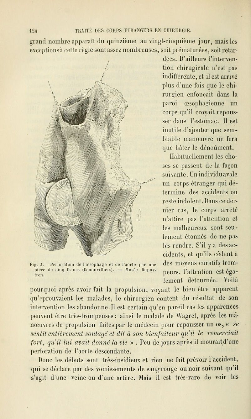 grand nombre apparaît du quinzième au vingt-cinquième jour, mais les exceptionsà cette règle sontassez nombreuses, soit prématurées, soit retar- dées. D'ailleurs l'interven- tion chirugicale n'est pas indifférente, et il est arrivé plus d'une fois que le chi- rurgien enfonçait dans la paroi œsophagienne un corps qu'il croyait repous- ser dans l'estomac. 11 est inutile d'ajouter que sem- blable manœuvre ne fera que hâter le dénoùment. Habituellement les cho- ses se passent de la façon suivante. Un individu avale un corps étranger qui dé- termine des accidents ou reste indolent. Dans ce der- nier cas, le corps arrêté n'attire pas l'attention et les malheureux sont seu- lement étonnés de ne pas les rendre. S'il y a des ac- cidents, et qu'ils cèdent à des moyens curatifs trom- peurs, l'attention est éga- lement détournée. Yoilà pourquoi après avoir fait la propulsion, voyant le bien être apparent qu'éprouvaient les malades, le chirurgien content du résultat de son intervention les abandonne.Il est certain qu'en pareil cas les apparences peuvent être très-trompeuses : ainsi le malade de Wagret, après les ma- nœuvres de propulsion faites par le médecin pour repousser un os, « se sentit entièrement soulagé et dit à so7i bienfaiteur qu'il le remerciait fort, qu'il lui avait donné la vie » . Peu de jours après il mouraitd'une perforation de l'aorte descendante. Donc les débuts sont très-insidieux et rien ne fait prévoir l'accident, qui se déclare par des vomissements de sang rouge ou noir suivant qu'il s'agit d'une veine ou d'une artère. Mais il est très-rare de voir les Fig. 4. — Perforation de rœsophage et de Paorte par une pièce de cinq francs (Denonvilliers). — Musée Dupuy- tren.