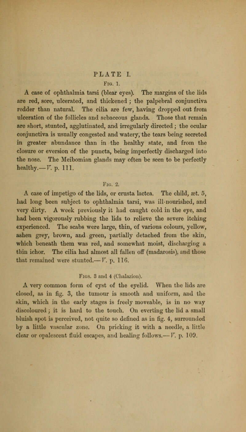 Fig. 1. A case of ophthalmia tarsi (blear eyes). The margins of the lids are red, sore, ulcerated, and thickened ; the palpebral conjunctiva redder than natural. The cilia are few, having dropped out from ulceration of the follicles and sebaceous glands. Those that remain are short, stunted, agglutinated, and irregularly directed; the ocular conjunctiva is usually congested and watery, the tears being secreted in greater abundance than in the healthy state, and from the closure or eversion of the puncta, being imperfectly discharged into the nose. The Meibomian glands may often be seen to be perfectly healthy.— V. p. 111. Pig. 2. A case of impetigo of the lids, or crusta lactea. The child, set. 5, had long been subject to ophthalmia tarsi, was ill-nourished, and very dirty. A week previously it had caught cold in the eye, and had been vigorously rubbing the lids to relieve the severe itching experienced. The scabs were large, thin, of various colours, yellow, ashen grey, brown, and green, partially detached from the skin, which beneath them was red, and somewhat moist, discharging a thin ichor. The cilia had almost all fallen off (madarosis), and those that remained were stunted.— V. p. 116. Figs. 3 and 4 (Chalazion). A very common form of cyst of the eyelid. When the lids arc closed, as in fig. 3, the tumour is smooth and uniform, and the skin, which in the early stages is freely moveable, is in no way discoloured; it is hard to the touch. On everting the lid a small bluish spot is perceived, not quite so defined as in fig. 4, surrounded by a little vascular zone. On pricking it with a needle, a little clear or opalescent fluid escapes, and healing follows.— V, p. 109.