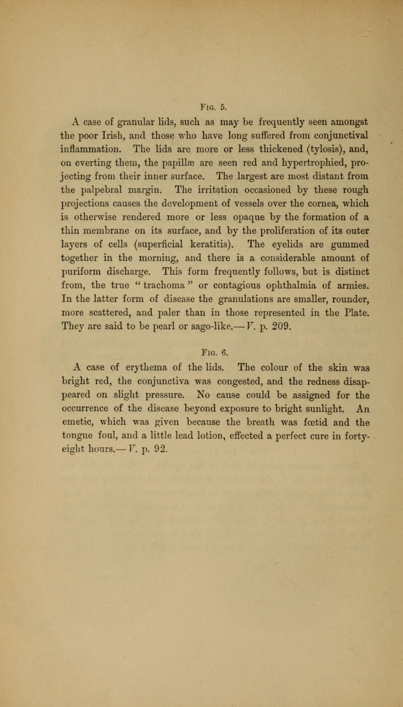 A case of granular lids, such as may be frequently seen amongst the poor Irish, and those who have long suffered from conjunctival inflammation. The lids are more or less thickened (tylosis), and, on everting them, the papillae are seen red and hypertrophied, pro- jecting from their inner surface. The largest are most distant from the palpebral margin. The irritation occasioned by these rough projections causes the development of vessels over the cornea, which is otherwise rendered more or less opaque by the formation of a thin membrane on its surface, and by the proliferation of its outer layers of cells (superficial keratitis). The eyelids are gummed together in the morning, and there is a considerable amount of puriform discharge. This form frequently follows, but is distinct from, the true  trachoma  or contagious ophthalmia of armies. In the latter form of disease the granulations are smaller, rounder, more scattered, and paler than in those represented in the Plate. They are said to be pearl or sago-like.— V. p. 209. Fig. 6. A case of erythema of the lids. The colour of the skin was bright red, the conjunctiva was congested, and the redness disap- peared on slight pressure. No cause could be assigned for the occurrence of the disease beyond exposure to bright sunlight. An emetic, which was given because the breath was foetid and the tongue foul, and a little lead lotion, effected a perfect cure in forty- eight hours.— V. p. 92.