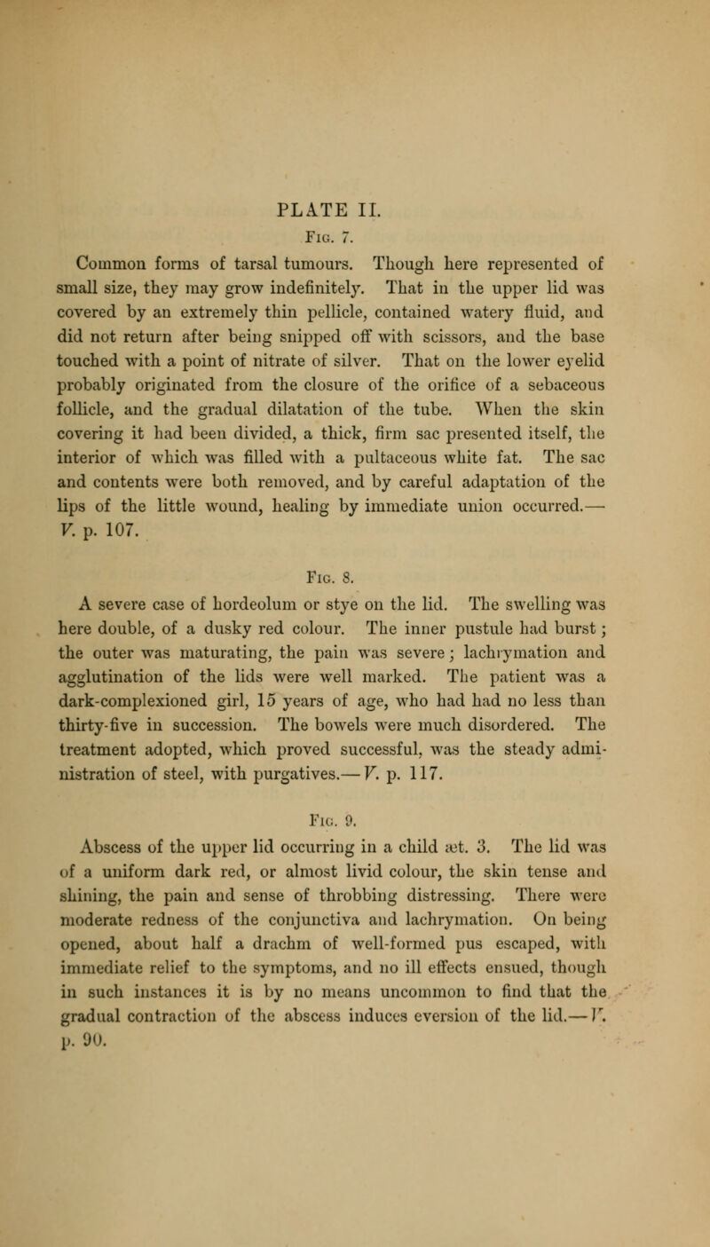 Fig. 7. Common forms of tarsal tumours. Though here represented of small size, they may grow indefinitely. That in the upper lid was covered by an extremely thin pellicle, contained watery fluid, and did not return after being snipped off with scissors, and the base touched with a point of nitrate of silver. That on the lower eyelid probably originated from the closure of the orifice of a sebaceous follicle, and the gradual dilatation of the tube. When the skin covering it had been divided, a thick, firm sac presented itself, the interior of which was filled with a pultaceous white fat. The sac and contents were both removed, and by careful adaptation of the lips of the little wound, healing by immediate union occurred.— V. p. 107. Fig. 8. A severe case of hordeolum or stye on the lid. The swelling was here double, of a dusky red colour. The inner pustule had burst; the outer was maturating, the pain was severe; lachi ymation and agglutination of the lids were well marked. The patient was a dark-complexioned girl, 15 years of age, who had had no less than thirty-five in succession. The bowels were much disordered. The treatment adopted, which proved successful, was the steady admi- nistration of steel, with purgatives.— V. p. 117. Pig. 9. Abscess of the upper lid occurring in a child set. 3. The lid was of a uniform dark red, or almost livid colour, the skin tense and shining, the pain and sense of throbbing distressing. There were moderate redness of the conjunctiva and lachrymation. On being opened, about half a drachm of well-formed pus escaped, with immediate relief to the symptoms, and no ill effects ensued, though in such instances it is by no means uncommon to find that the gradual contraction of the abscess induces eversion of the lid.— V. [>. 90.