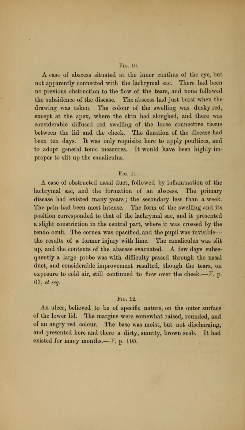 A case of abscess situated at the inner canthus of the eye, but not apparently connected with the lachrymal sac. There had been no previous obstruction to the flow of the tears, and none followed the subsidence of the disease. The abscess had just burst when the drawing was taken. The colour of the swelling was dusky-red, except at the apex, where the skin had sloughed, and there was considerable diffused red swelling of the loose connective tissue between the lid and the cheek. The duration of the disease had been ten days. It was only requisite here to apply poultices, and to adopt general tonic measures. It would have been highly im- proper to slit up the canaliculus. Fig. 11. A case of obstructed nasal duct, followed by inflammation of the lachrymal sac, and the formation of an abscess. The primary disease had existed many years; the secondary less than a week. The pain had been most intense. The form of the swelling and its position corresponded to that of the lachrymal sac, and it presented a slight constriction in the central part, where it was crossed by the tendo oculi. The cornea was opacified, and the pupil was invisible— the results of a former injury with lime. The canaliculus was slit up, and the contents of the abscess evacuated. A few days subse- quently a large probe was with difficulty passed through the nasal duct, and considerable improvement resulted, though the tears, on exposure to cold air, still continued to flow over the cheek.—V. p. 67, et seq. Fig. 12. An ulcer, believed to be of specific nature, on the outer surface of the lower lid. The margins were somewhat raised, rounded, and of an angry red colour. The base was moist, but not discharging, and presented here and there a dirty, smutty, brown scab. It had existed for many months.— V. p. 105.