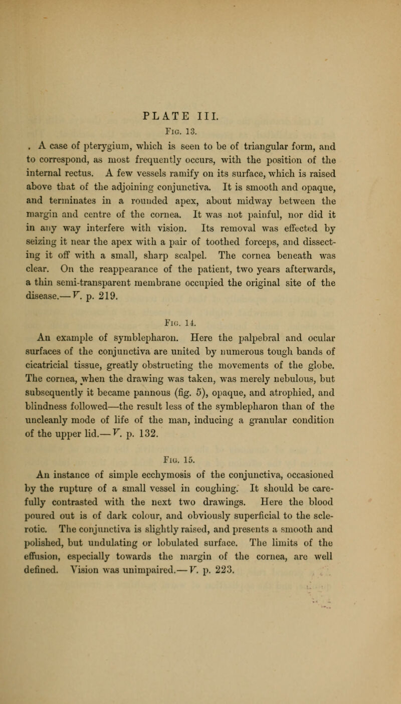 PLATE III. Fig. 13. . A case of pterygium, which is seen to be of triangular form, and to correspond, as most frequently occurs, with the position of the internal rectus. A few vessels ramify on its surface, which is raised above that of the adjoining conjunctiva. It is smooth and opaque, and terminates in a rounded apex, about midway between the margin and centre of the cornea. It was not painful, nor did it in any way interfere with vision. Its removal was effected by seizing it near the apex with a pair of toothed forceps, and dissect- ing it off with a small, sharp scalpel. The cornea beneath was clear. On the reappearance of the patient, two years afterwards, a thin semi-transparent membrane occupied the original site of the disease.— V. p. 219. Fig. 14. An example of symblepharon. Here the palpebral and ocular surfaces of the conjunctiva are united by numerous tough bands of cicatricial tissue, greatly obstructing the movements of the globe. The cornea, when the drawing was taken, was merely nebulous, but subsequently it became pannous (fig. 5), opaque, and atrophied, and blindness followed—the result less of the symblepharon than of the uncleanly mode of life of the man, inducing a granular condition of the upper lid.— V. p. 132. Fig. 15. An instance of simple ecchymosis of the conjunctiva, occasioned by the rupture of a small vessel in coughing. It should be care- fully contrasted with the next two drawings. Here the blood poured out is of dark colour, and obviously superficial to the scle- rotic. The conjunctiva is slightly raised, and presents a smooth and polished, but undulating or lobulated surface. The limits of the effusion, especially towards the margin of the cornea, are well defined. Vision was unimpaired.—V. p. 223.