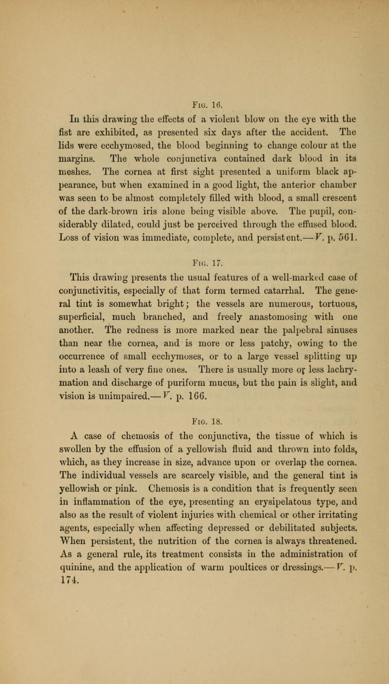 In this drawing the effects of a violent blow on the eye with the fist are exhibited, as presented six days after the accident. The lids were ecchymosed, the blood beginning to change colour at the margins. The whole conjunctiva contained dark blood in its meshes. The cornea at first sight presented a uniform black ap- pearance, but when examined in a good light, the anterior chamber was seen to be almost completely filled with blood, a small crescent of the dark-brown iris alone being visible above. The pupil, con- siderably dilated, could just be perceived through the effused blood. Loss of vision was immediate, complete, and persistent.— V. p. 561. Fig. 17. This drawing presents the usual features of a well-marked case of conjunctivitis, especially of that form termed catarrhal. The gene- ral tint is somewhat bright; the vessels are numerous, tortuous, superficial, much branched, and freely anastomosing with one another. The redness is more marked near the palpebral sinuses than near the cornea, and is more or less patchy, owing to the occurrence of small ecchymoses, or to a large vessel splitting up into a leash of very fine ones. There is usually more or less lachry- mation and discharge of puriform mucus, but the pain is slight, and vision is unimpaired.— V. p. 166. Fig. 18. A case of chemosis of the conjunctiva, the tissue of which is swollen by the effusion of a yellowish fluid and thrown into folds, which, as they increase in size, advance upon or overlap the cornea. The individual vessels are scarcely visible, and the general tint is yellowish or pink. Chemosis is a condition that is frequently seen in inflammation of the eye, presenting an erysipelatous type, and also as the result of violent injuries with chemical or other irritating agents, especially when affecting depressed or debilitated subjects. When persistent, the nutrition of the cornea is always threatened. As a general rule, its treatment consists in the administration of quinine, and the application of warm poultices or dressings.— V. p. 174.