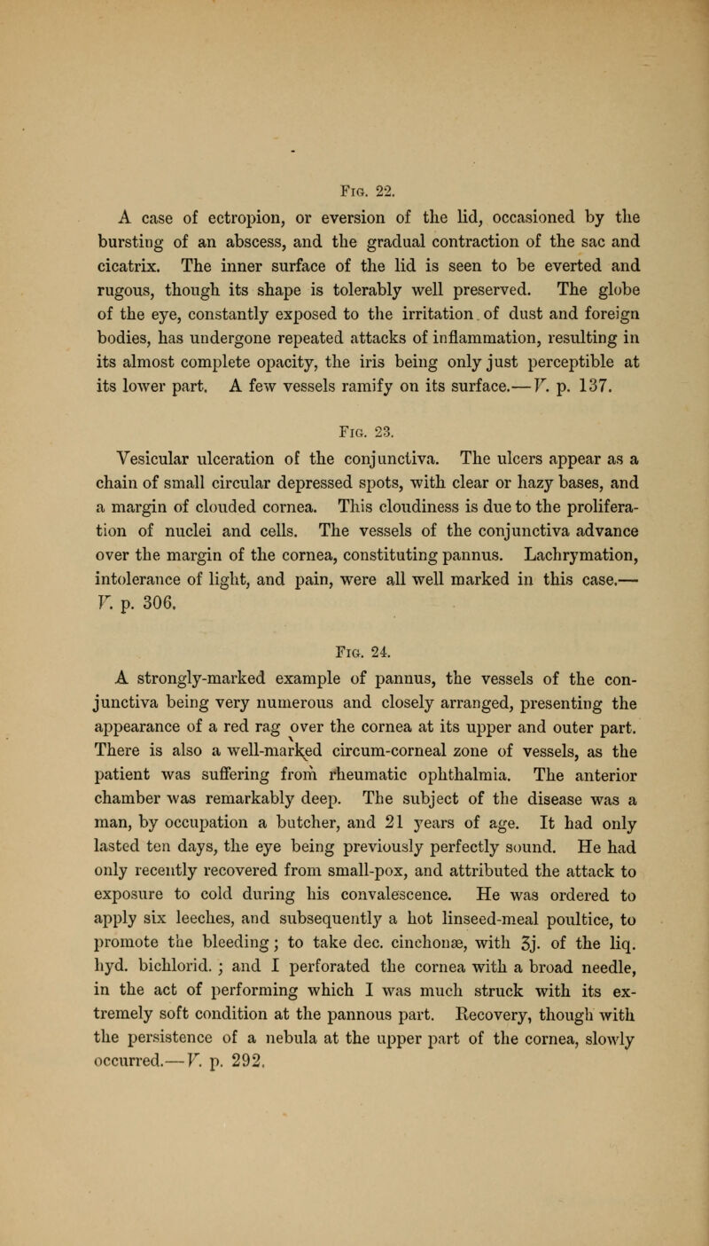 A case of ectropion, or eversion of the lid, occasioned by the bursting of an abscess, and the gradual contraction of the sac and cicatrix. The inner surface of the lid is seen to be everted and rugous, though its shape is tolerably well preserved. The globe of the eye, constantly exposed to the irritation. of dust and foreign bodies, has undergone repeated attacks of inflammation, resulting in its almost complete opacity, the iris being only just perceptible at its lower part. A few vessels ramify on its surface.— V. p. 137. Fig. 23. Vesicular ulceration of the conjunctiva. The ulcers appear as a chain of small circular depressed spots, with clear or haz}' bases, and a margin of clouded cornea. This cloudiness is due to the prolifera- tion of nuclei and cells. The vessels of the conjunctiva advance over the margin of the cornea, constituting pannus. Lachrymation, intolerance of light, and pain, were all well marked in this case.— F. p. 306, Fig. 24. A strongly-marked example of pannus, the vessels of the con- junctiva being very numerous and closely arranged, presenting the appearance of a red rag over the cornea at its upper and outer part. There is also a well-marked circum-corneal zone of vessels, as the patient was suffering from rheumatic ophthalmia. The anterior chamber was remarkably deep. The subject of the disease was a man, by occupation a butcher, and 21 years of age. It had only lasted ten days, the eye being previously perfectly sound. He had only recently recovered from small-pox, and attributed the attack to exposure to cold during his convalescence. He was ordered to apply six leeches, and subsequently a hot linseed-meal poultice, to promote the bleeding; to take dec. cinchonas, with 3j. of the liq. hyd. bichlorid. ; and I perforated the cornea with a broad needle, in the act of performing which I was much struck with its ex- tremely soft condition at the pannous part. Recovery, though with the persistence of a nebula at the upper part of the cornea, slowly occurred.—V. p. 292.