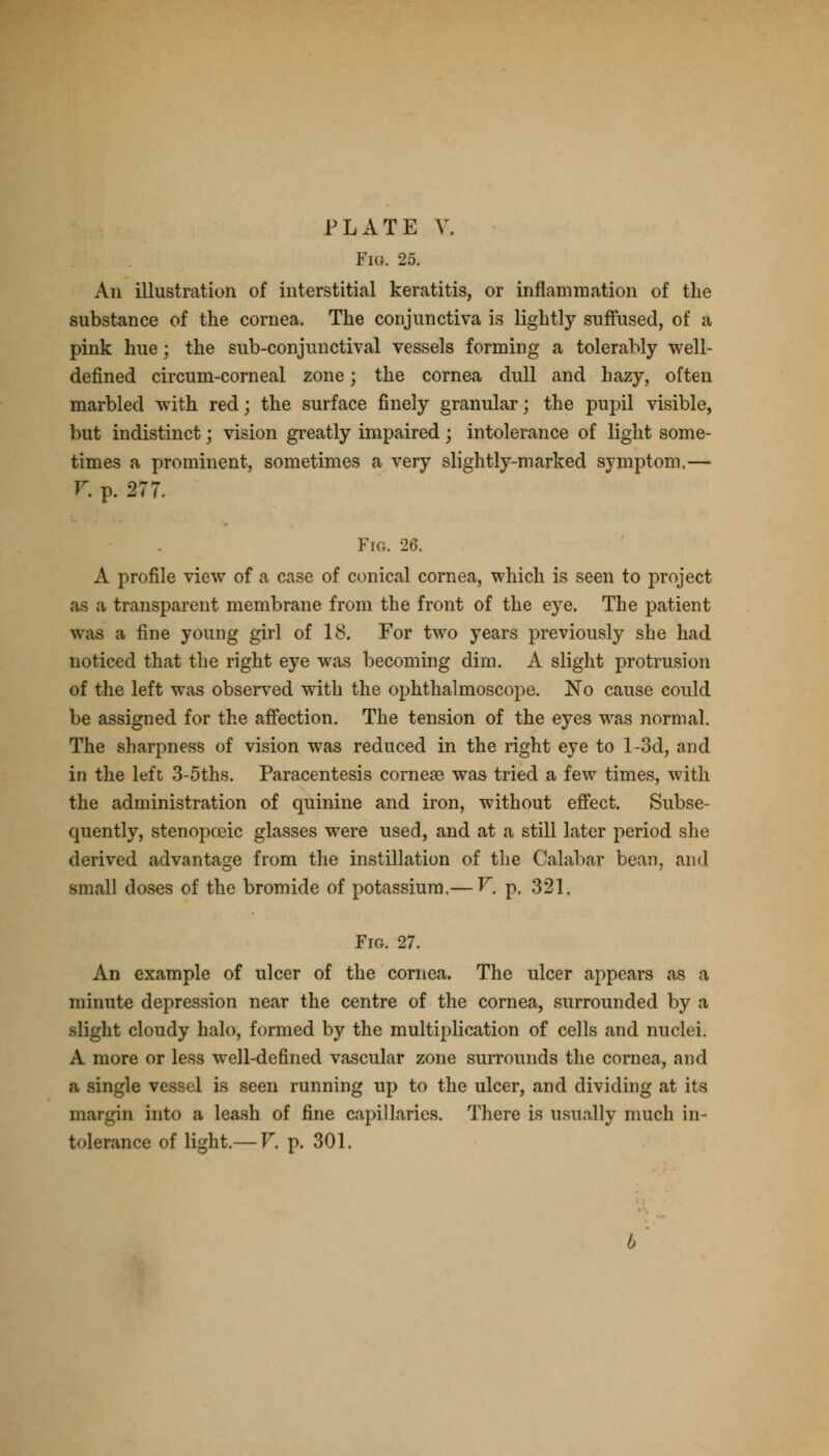 Fig. 25. An illustration of interstitial keratitis, or inflammation of the substance of the cornea. The conjunctiva is lightly suffused, of a pink hue; the sub-conjunctival vessels forming a tolerably well- defined circum-corneal zone; the cornea dull and hazy, often marbled with red; the surface finely granular; the pupil visible, but indistinct; vision greatly impaired ; intolerance of light some- times a prominent, sometimes a very slightly-marked symptom,— V. p. 277. Fig. 26. A profile view of a case of conical cornea, which is seen to project as a transparent membrane from the front of the eye. The patient was a fine young girl of 18. For two years previously she had noticed that the right eye was becoming dim. A slight protrusion of the left was observed with the ophthalmoscope. No cause could be assigned for the affection. The tension of the eyes was normal. The sharpness of vision was reduced in the right eye to l-3d, and in the left 3-5ths. Paracentesis corneas was tried a few times, with the administration of quinine and iron, without effect. Subse- quently, stenopceic glasses were used, and at a still later period she derived advantage from the instillation of the Calabar bean, and small doses of the bromide of potassium.— V. p. 321. Fig. 27. An example of ulcer of the cornea. The ulcer appears as a minute depression near the centre of the cornea, surrounded by a slight cloudy halo, formed by the multiplication of cells and nuclei. A more or less well-defined vascular zone surrounds the cornea, and a single vessel is seen running up to the ulcer, and dividing at its margin into a leash of fine capillaries. There is usually much in- tolerance of light.— V. p. 301.