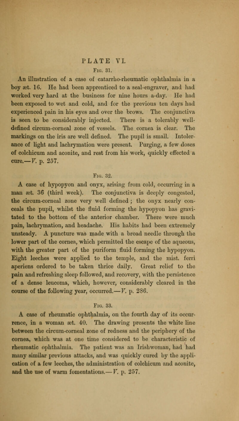 Fig. 31. An illustration of a case of catarrho-rlieuraatic ophthalmia in a boy set. 16. He had been apprenticed to a seal-engraver, and had worked very hard at the business for nine hours a-day. He had been exposed to wet and cold, and for the previous ten days had experienced pain in his eyes and over the brows. The conjunctiva is seen to be considerably injected. There is a tolerably well- defined circum-corneal zone of vessels. The cornea is clear. The markings on the iris are well defined. The pupil is small. Intoler- ance of light and lachrymation were present. Purging, a few doses of colchicum and aconite, and rest from his work, quickly effected a cure.— V. p. 257. Fig. 32. A case of hypopyon and onyx, arising from cold, occurring in a man aet. 36 (third week). The conjunctiva is deeply congested, the circum-corneal zone very well defined ; the onyx nearly con- ceals the pupil, whilst the fluid forming the hypopyon has gravi- tated to the bottom of the anterior chamber. There were much pain, lachrymation, and headache. His habits had been extremely unsteady. A puncture was made with a broad needle through the lower part of the cornea, which permitted the escape of the aqueous, with the greater part of the puriform fluid forming the hypopyon. Eight leeches were applied to the temple, and the mist, ferri aperiens ordered to be taken thrice daily. Great relief to the pain and refreshing sleep followed, and recovery, with the persistence of a dense leucoma, which, however, considerably cleared in the course of the following year, occurred.—V. p. 2S6. Fio. 33. A case of rheumatic ophthalmia, on the fourth day of its occur- rence, in a woman aet. 40. The drawing presents the white line between the circum-corneal zone of redness and the periphery of the cornea, which was at one time considered to be characteristic of rheumatic ophthalmia, The patient was an Irishwoman, had had many similar previous attacks, and was quickly cured by the ampli- cation of a few leeches, the administration of colchicum and aconite, and the use of warm fomentations.—V. p. 257.