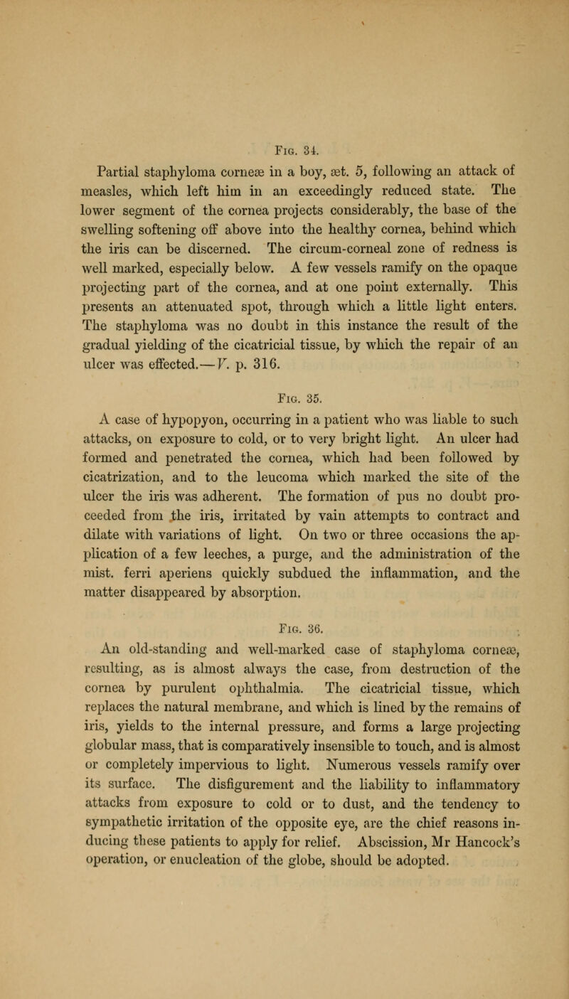Fig. 31 Partial staphyloma comese in a boy, set. 5, following an attack of measles, which left him in an exceedingly reduced state. The lower segment of the cornea projects considerably, the base of the swelling softening off above into the healthy cornea, behind which the iris can be discerned. The circum-corneal zone of redness is well marked, especially below. A few vessels ramify on the opaque projecting part of the cornea, and at one point externally. This presents an attenuated spot, through which a little light enters. The staphyloma was no doubt in this instance the result of the gradual yielding of the cicatricial tissue, by which the repair of an ulcer was effected.—V. p. 316. Fig. 35. A case of hypopyon, occurring in a patient who was liable to such attacks, on exposure to cold, or to very bright light. An ulcer had formed and penetrated the cornea, which had been followed by cicatrization, and to the leucoma which marked the site of the ulcer the iris was adherent. The formation of pus no doubt pro- ceeded from the iris, irritated by vain attempts to contract and dilate with variations of light. On two or three occasions the ap- plication of a few leeches, a purge, and the administration of the mist, ferri aperiens quickly subdued the inflammation, and the matter disappeared by absorption. Fig. 36. An old-standing and well-marked case of staphyloma corn ere, resulting, as is almost always the case, from destruction of the cornea by purulent ophthalmia. The cicatricial tissue, which replaces the natural membrane, and which is lined by the remains of iris, yields to the internal pressure, and forms a large projecting globular mass, that is comparatively insensible to touch, and is almost or completely impervious to light. Numerous vessels ramify over its surface. The disfigurement and the liability to inflammatory attacks from exposure to cold or to dust, and the tendency to sympathetic irritation of the opposite eye, are the chief reasons in- ducing these patients to apply for relief. Abscission, Mr Hancock's operation, or enucleation of the globe, should be adopted.